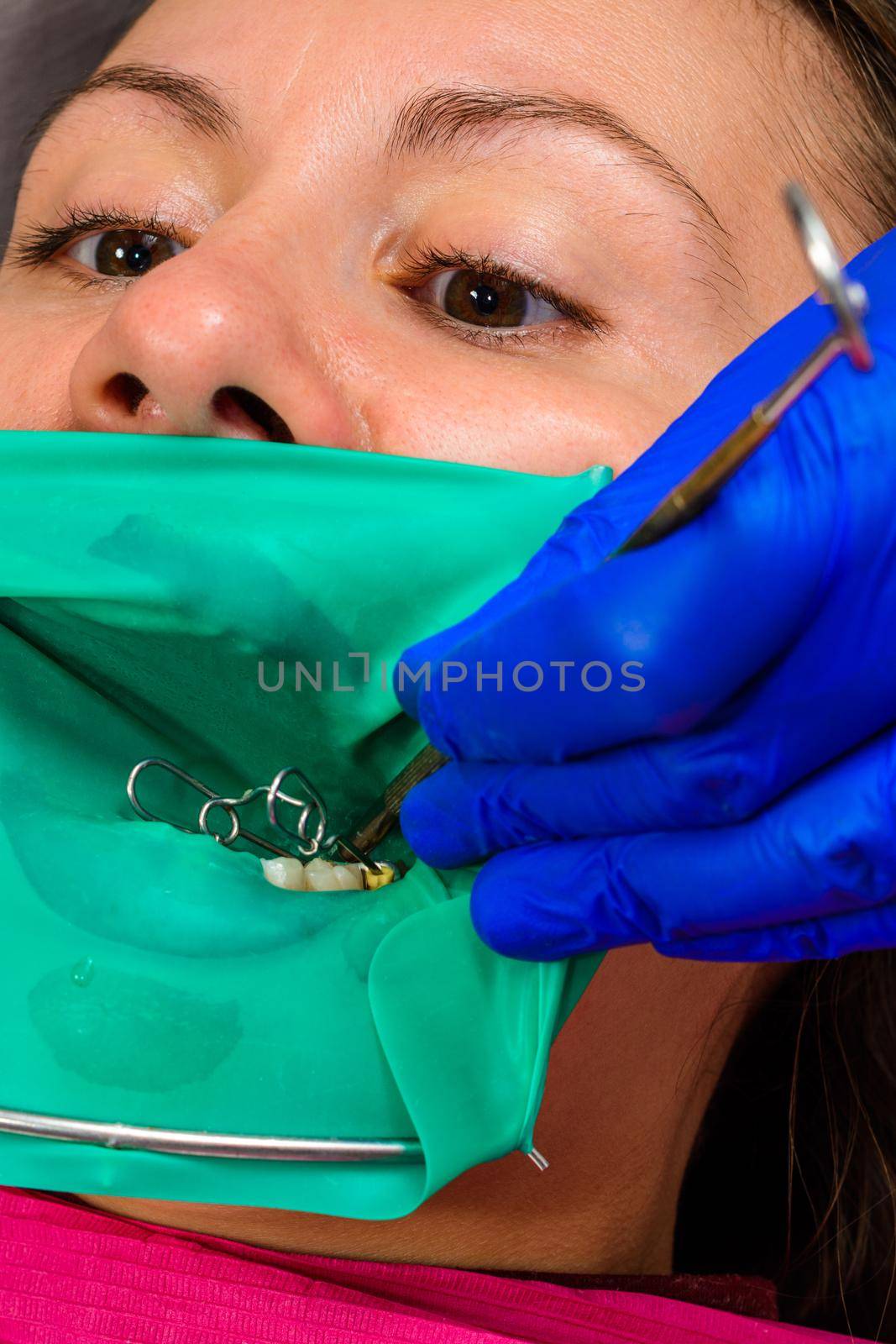 The dentist treats the patient's tooth with a rubber dam, drill, mirror.2020