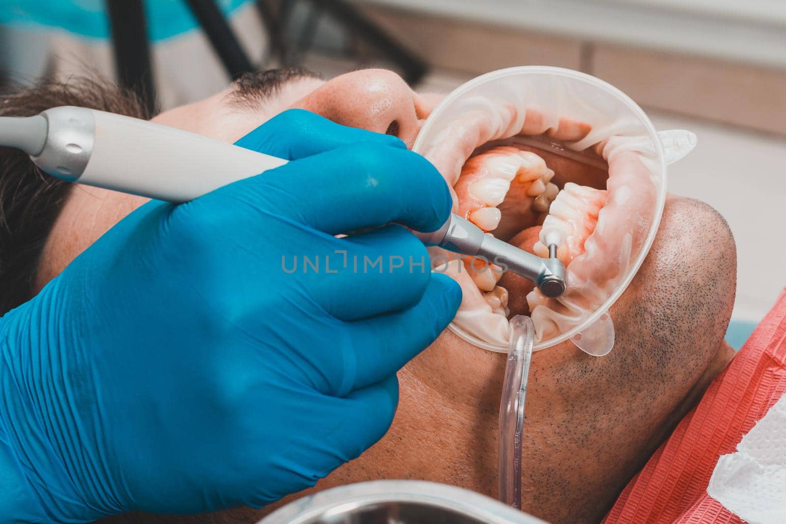 patient removing tartar,the dentist uses ultrasound to remove tartar,dental scaler. by Niko_Cingaryuk