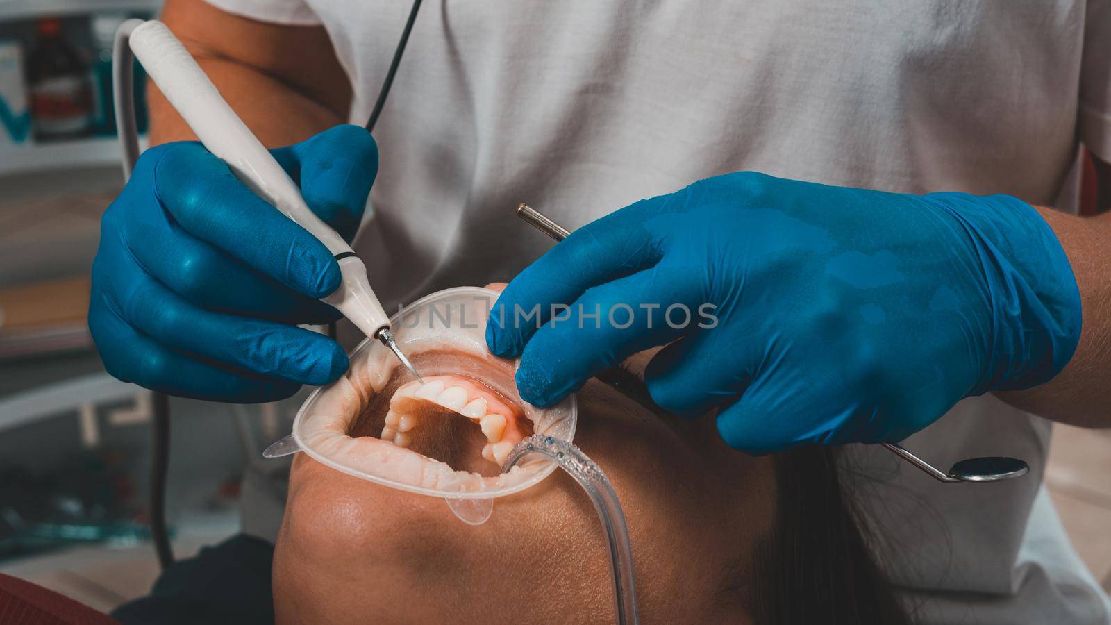 At the dentist's appointment, tartar removal, use of ultrasound, patient and dentist. Retractor for isolation of lips and gums. 2020