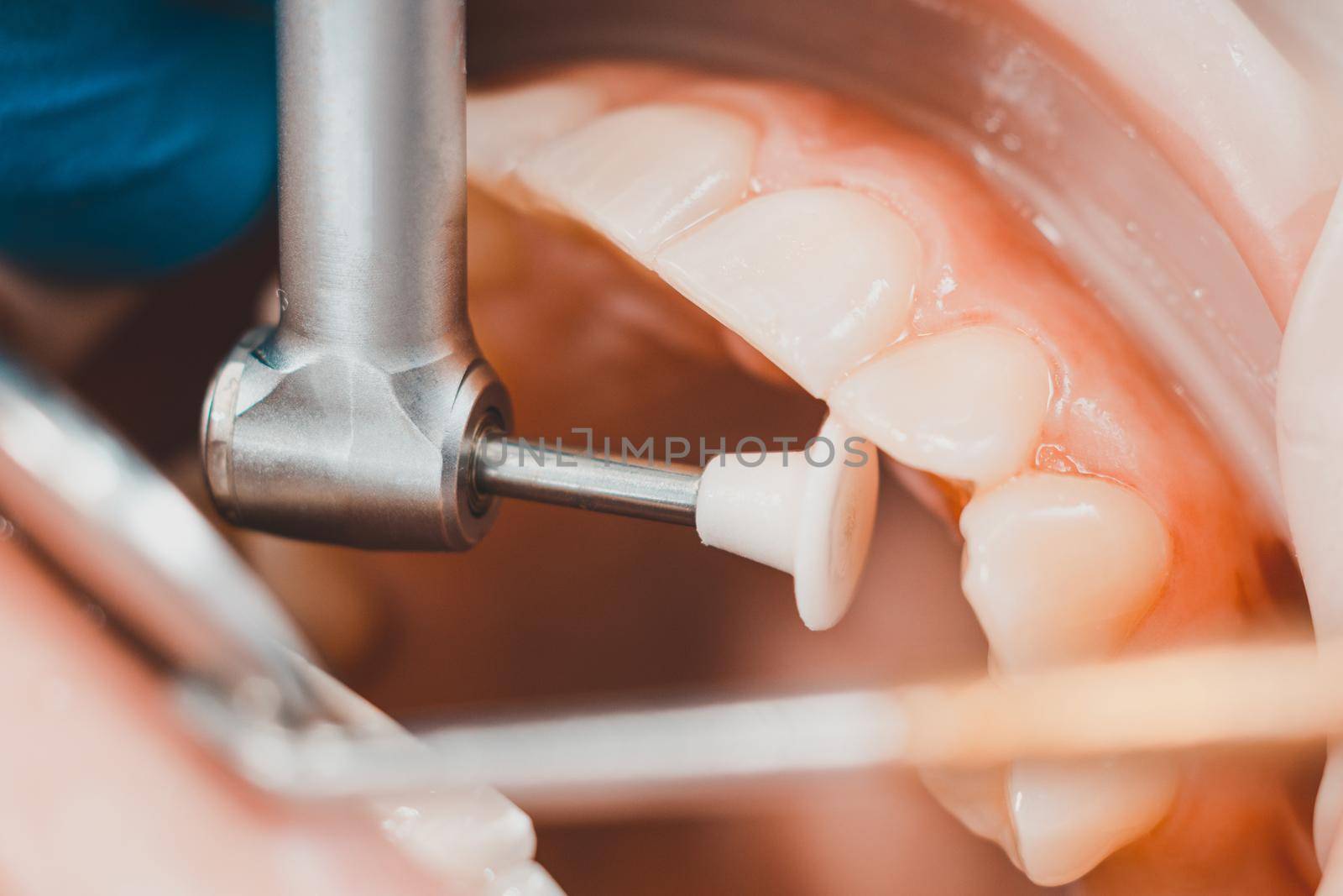 The dentist polishes the teeth with a drill, a dental procedure. Teeth polishing macro. by Niko_Cingaryuk