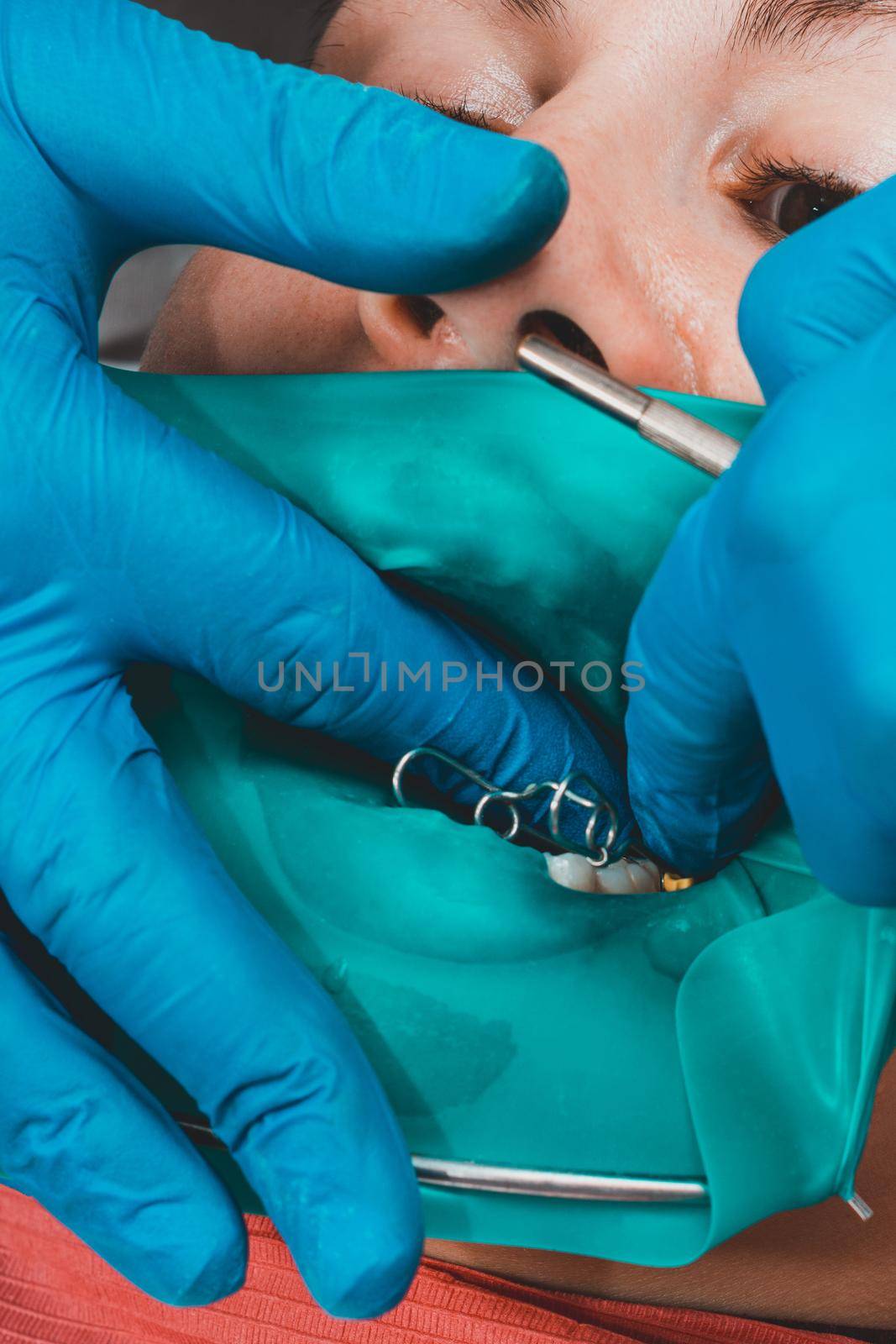 The dentist treats the patient's tooth with a rubber dam, drill, mirror. by Niko_Cingaryuk