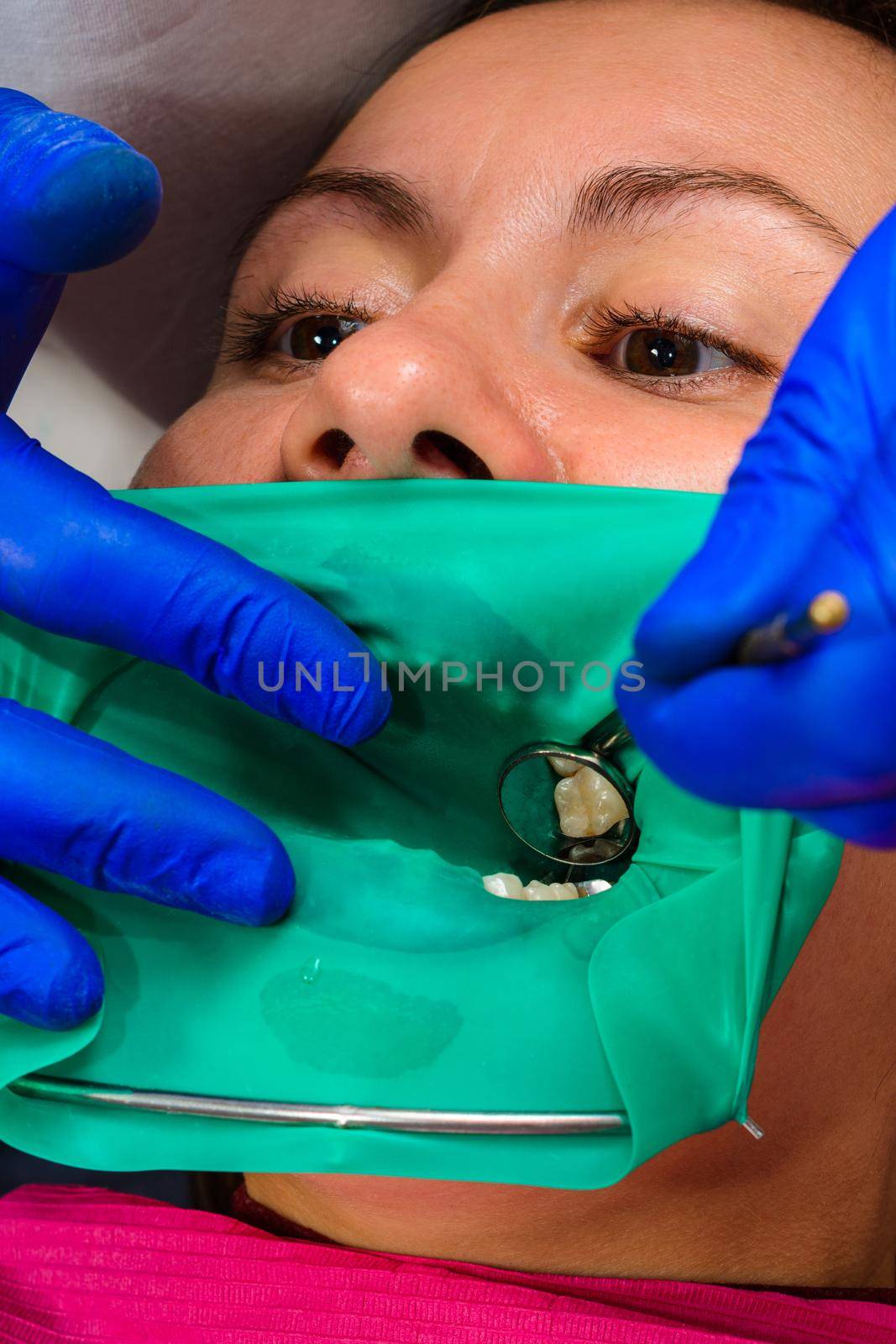 The dentist treats the patient's tooth with a rubber dam, drill, mirror.2020