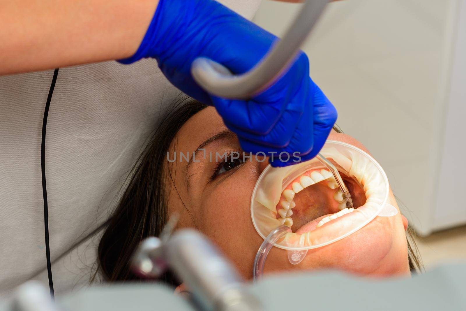 After cleaning the teeth from tartar, the dentist rinses them with water, using only sterile instruments.2020