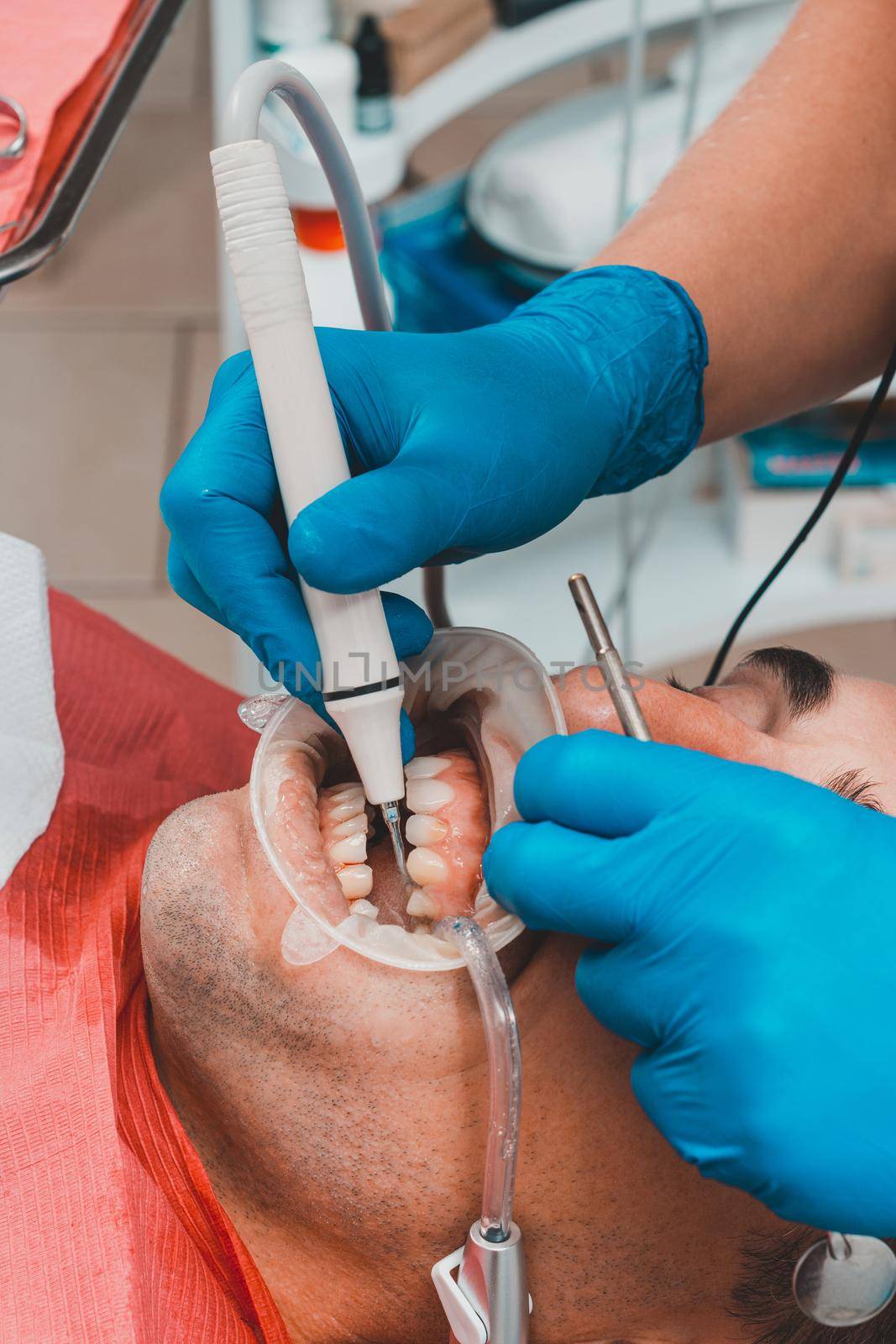 patient removing tartar,the dentist uses ultrasound to remove tartar,dental scaler. by Niko_Cingaryuk