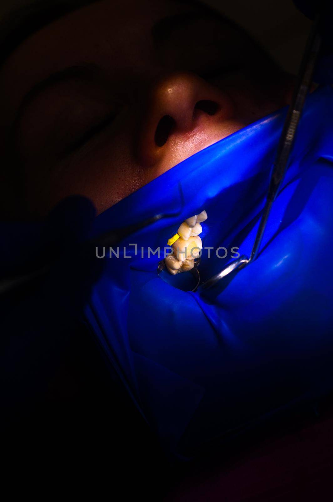 Close-up of the patient's mouth after filling the teeth with white composite resin on the insulation of a rubber dam, rubber dam and dental mirror. new