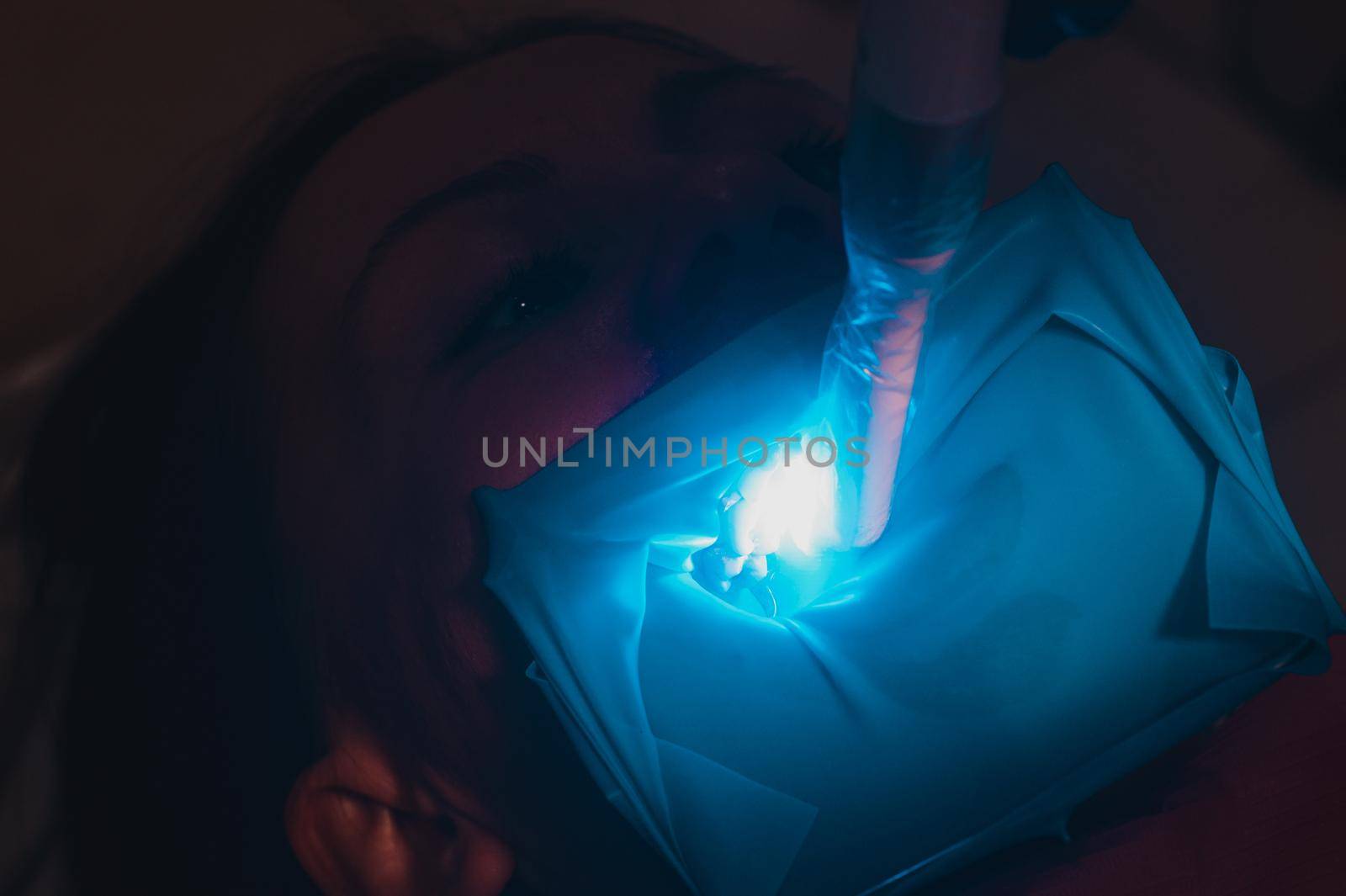 Ultraviolet light in dentistry, treatment of upper masticatory teeth. new