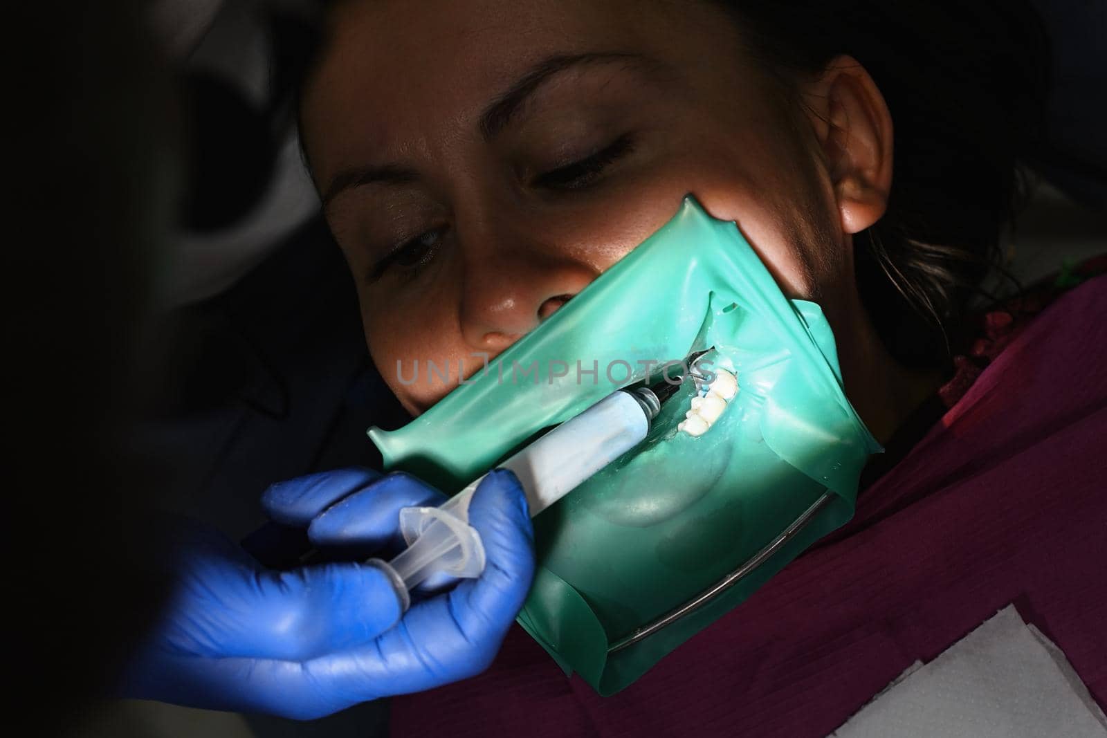 The dentist uses a blue gel to treat the patient's tooth. A woman at a dentist's appointment, a dentist uses a rubber dam and dental tools for treatment.2020