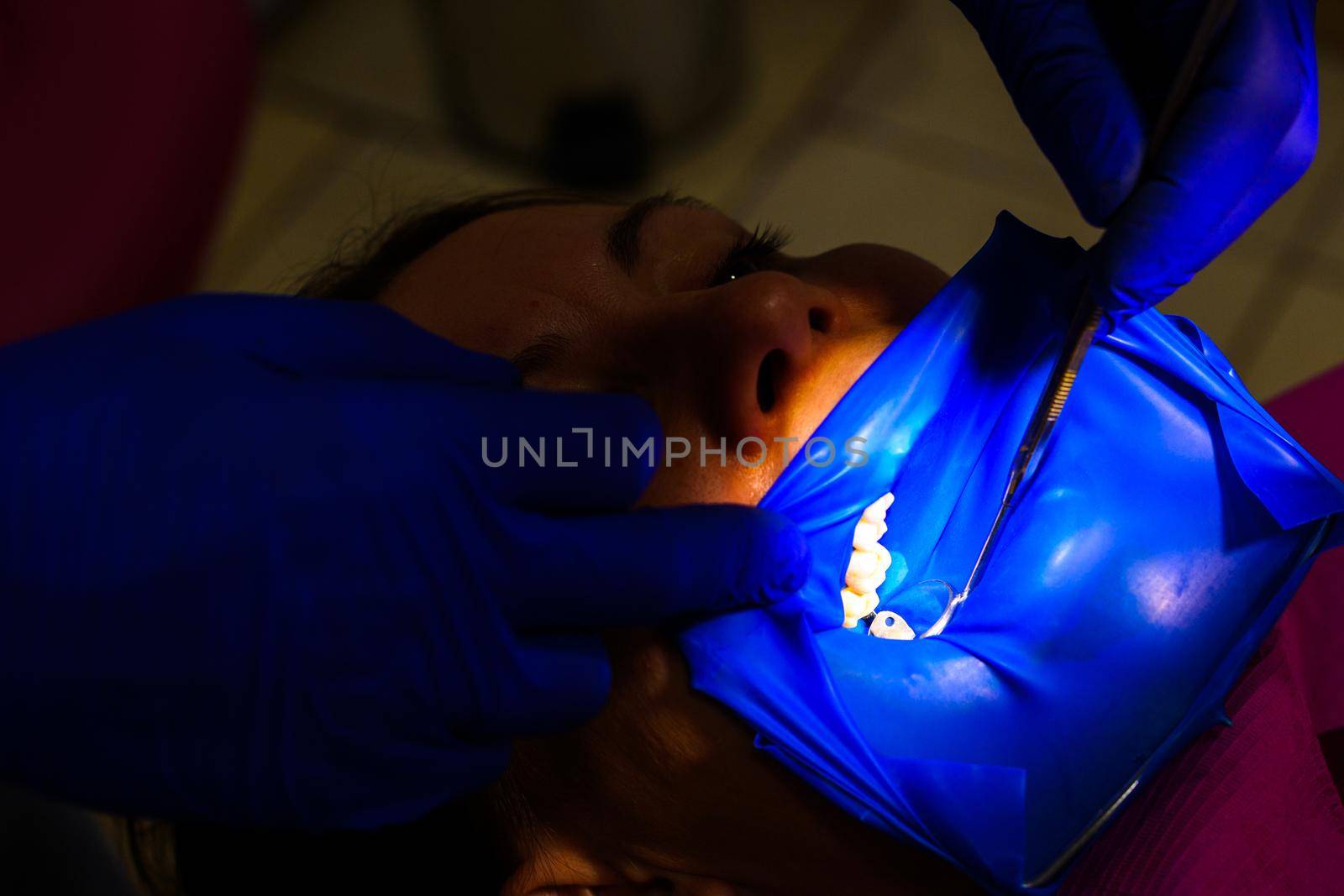 Dental procedure, treatment of the upper masticatory tooth, modern dental treatment with a rubber dam. by Niko_Cingaryuk