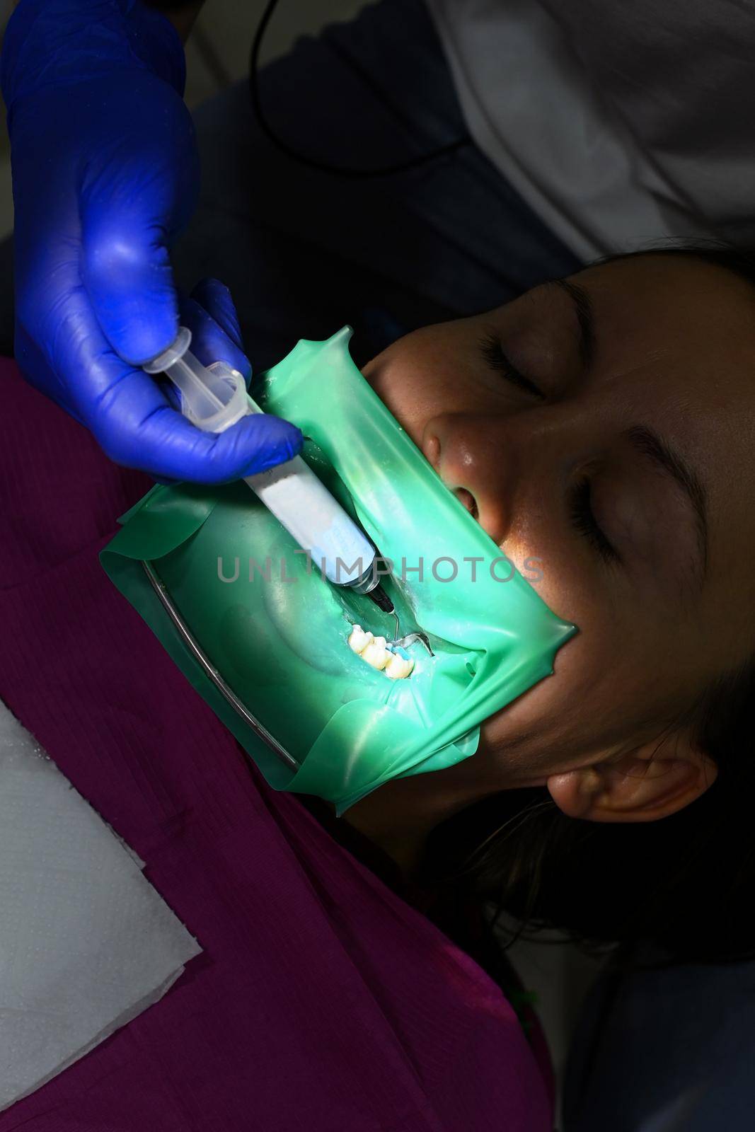 The dentist uses a blue gel to treat the patient's tooth. A woman at a dentist's appointment, a dentist uses a rubber dam and dental tools for treatment. by Niko_Cingaryuk