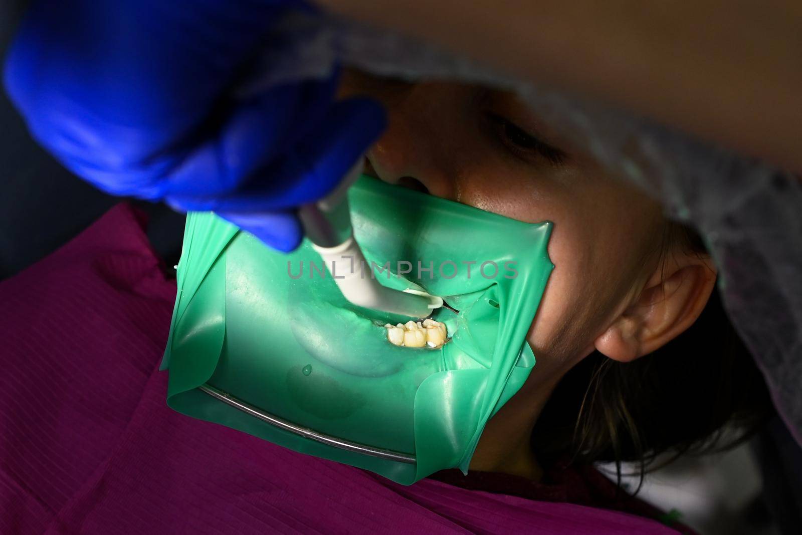 A woman at a dentist's appointment, a dentist uses a rubber dam and dental tools for treatment.2020