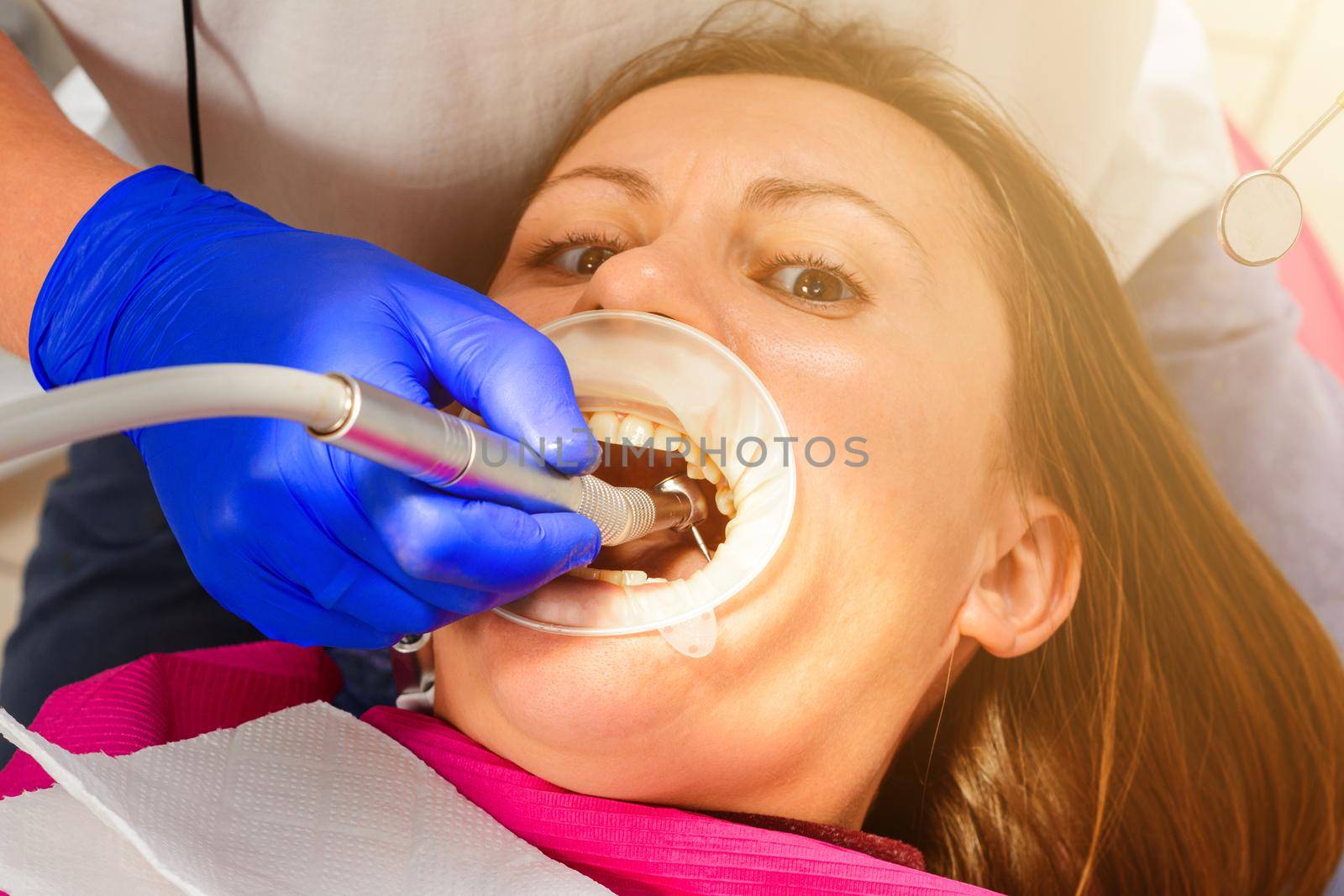 Patient and dentist, examination and treatment of masticatory teeth, removal of old fillings, use of a retractor.2020