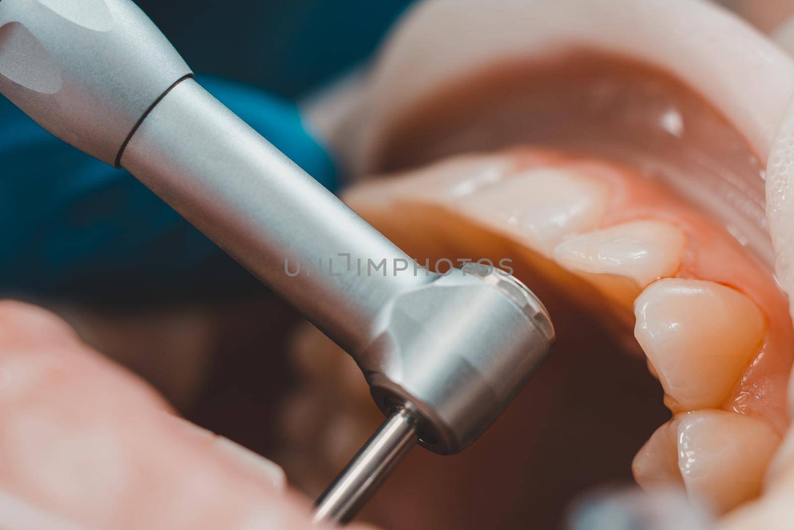 The dentist polishes the teeth with a drill, a dental procedure. Teeth polishing macro 2020