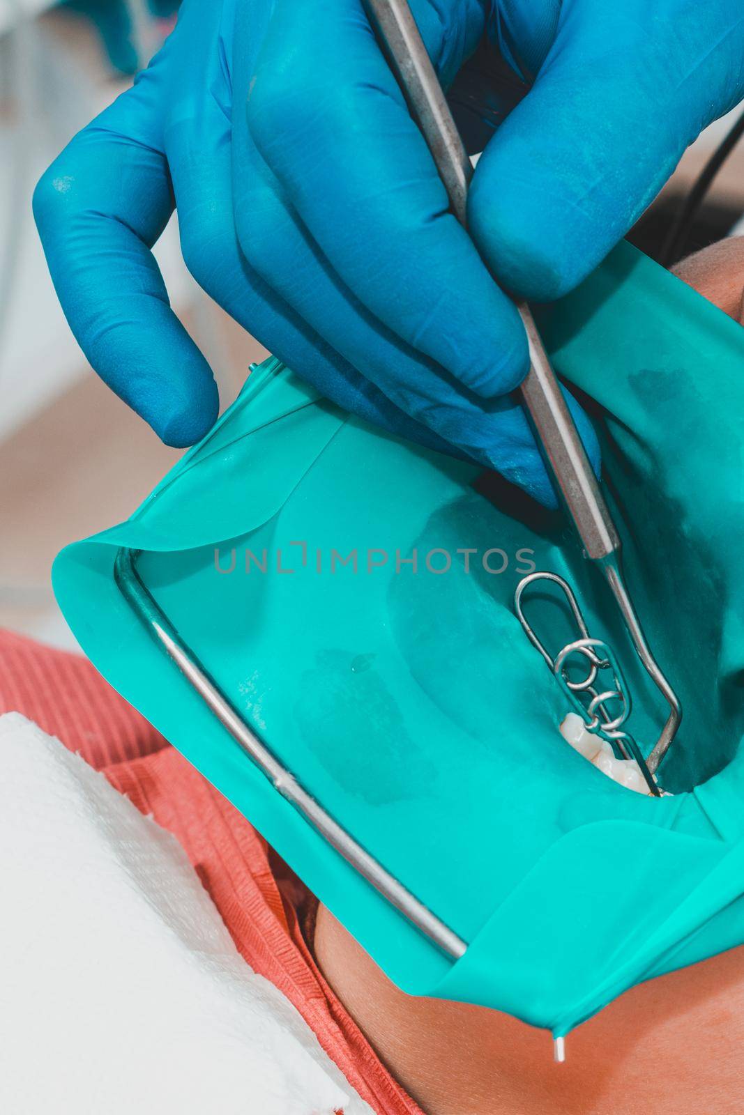 Dental restoration and polymerization of tooth composite materials, the doctor conducts sterile work on tooth restoration.2020
