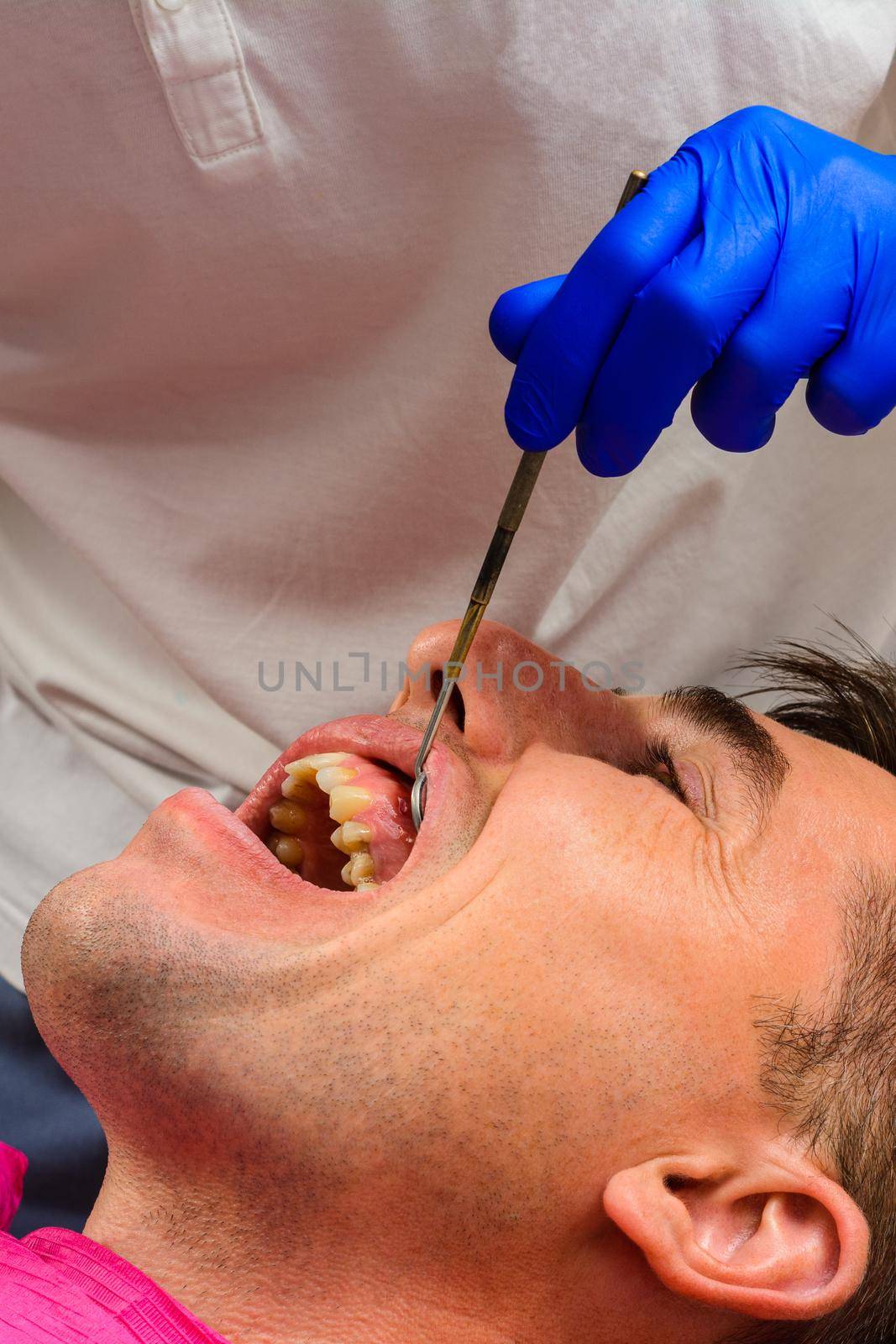 Visiting the dentist, the dentist evaluates the oral cavity and identifies problem areas of the teeth. Fistula mouth.
