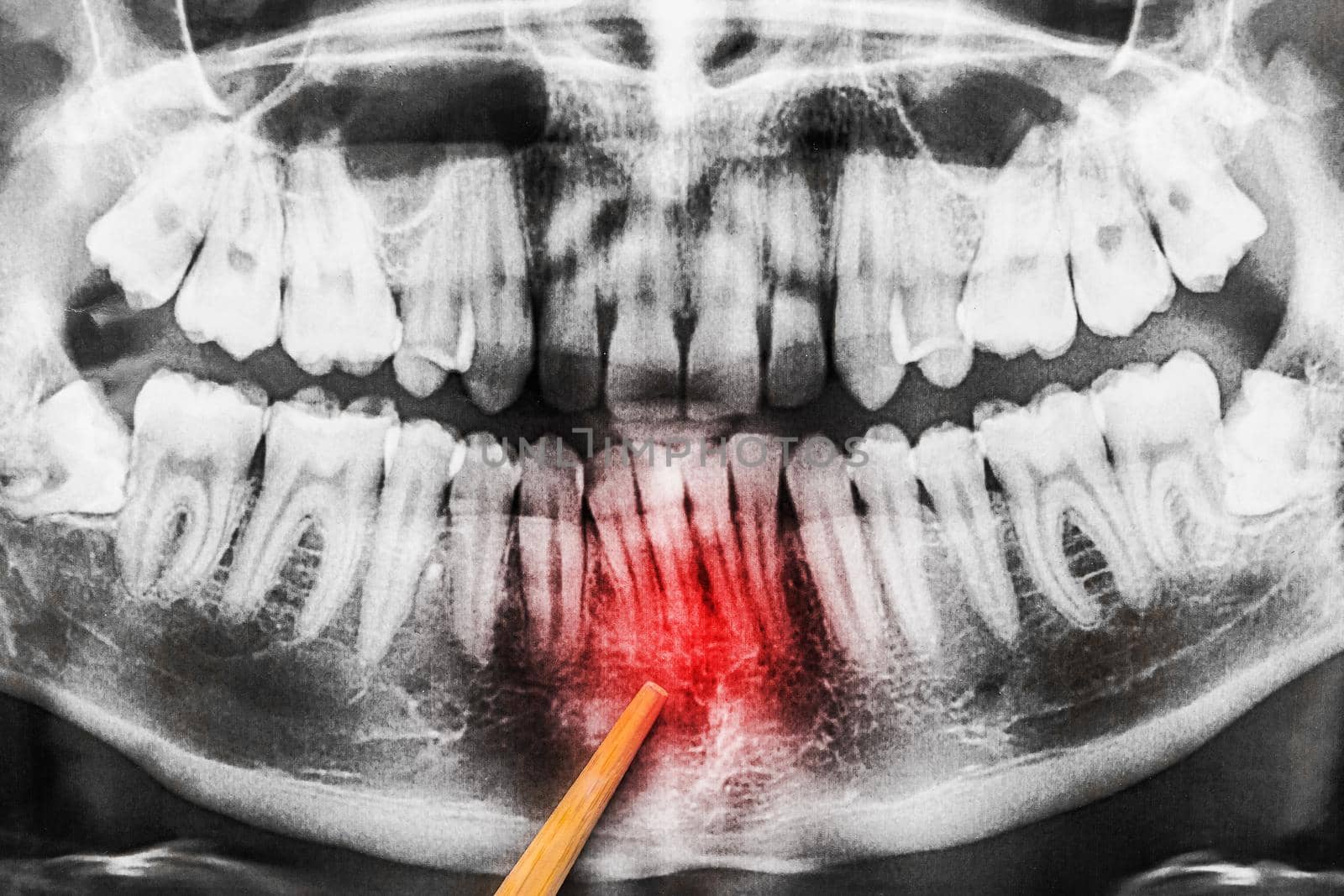 The process of curvature of the teeth in the lower jaw on the X-ray image of the oral cavity, close-up.