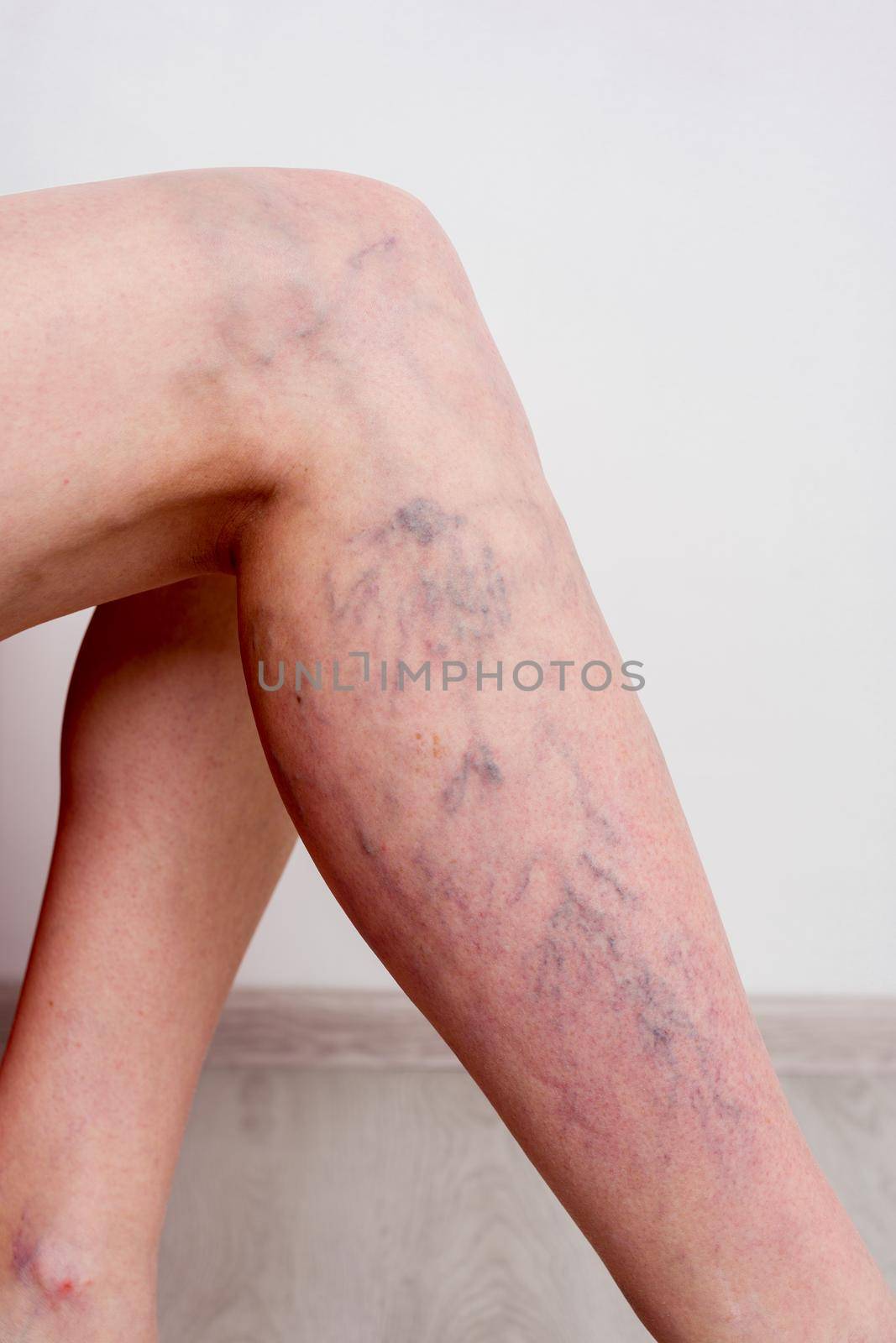 Varicose veins on a slim female legs. Phlebology by zartarn