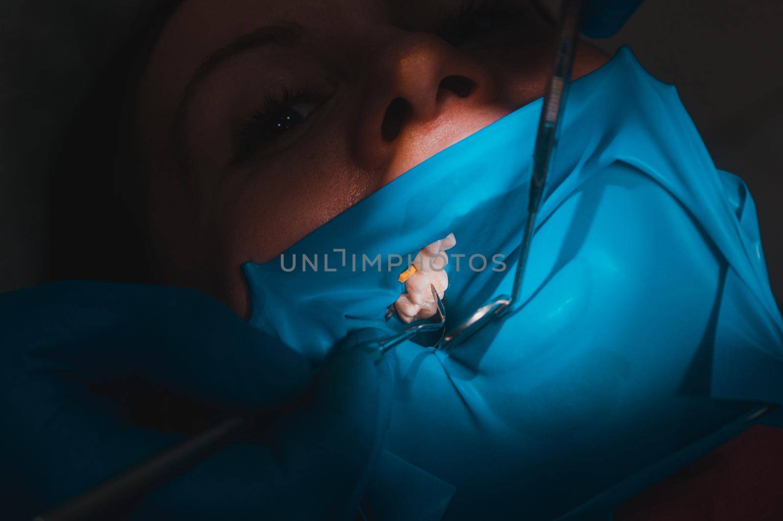 Close-up of the patient's mouth after filling the teeth with white composite resin on the insulation of a rubber dam, rubber dam and dental mirror. by Niko_Cingaryuk