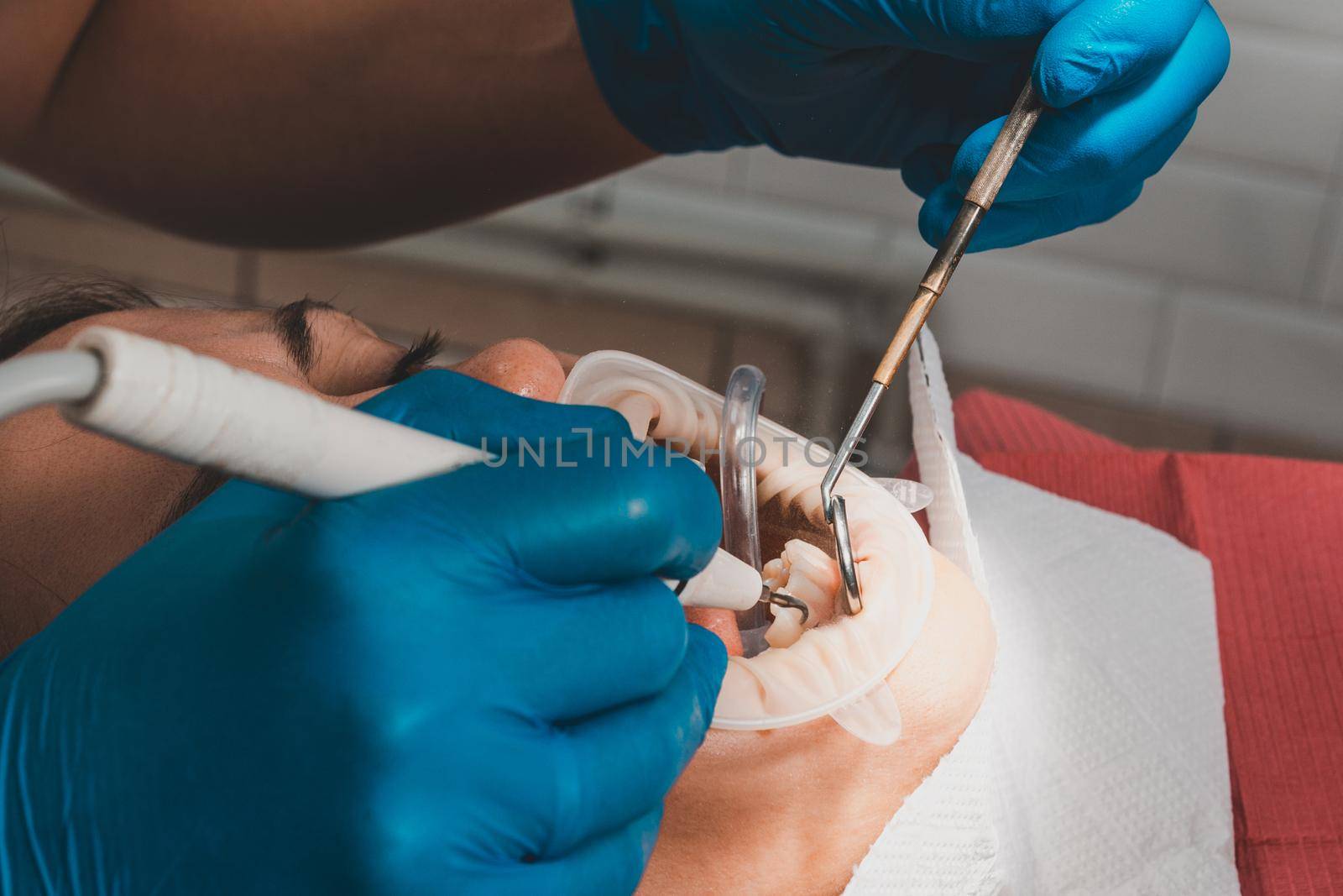 The dentist removes tartar using ultrasound, the patient at the dentist. Retractor for isolation of lips and gums. 2020