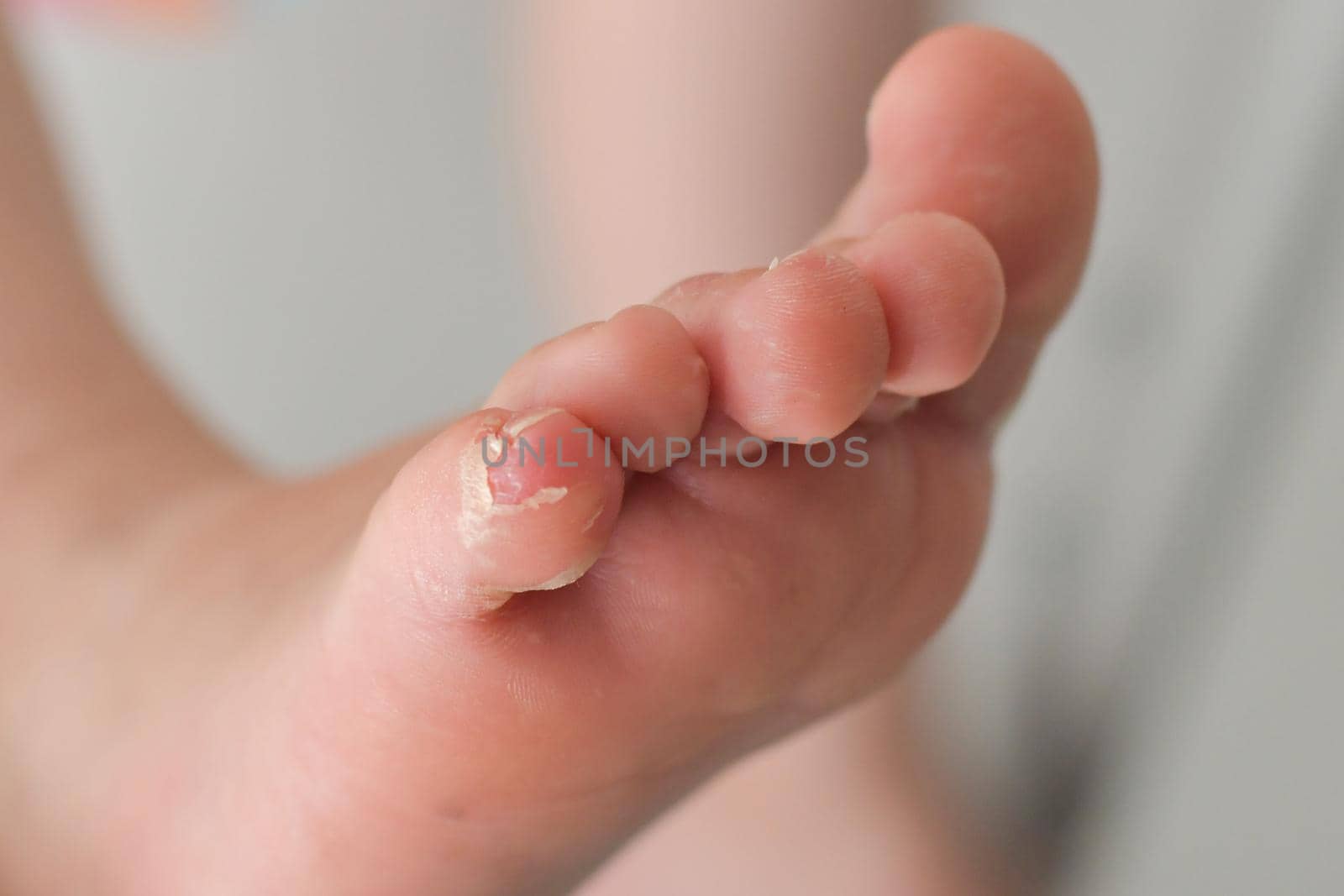 Enterovirus foot hand mouth disease Skin peeled off on the legs of a child Cocksackie virus