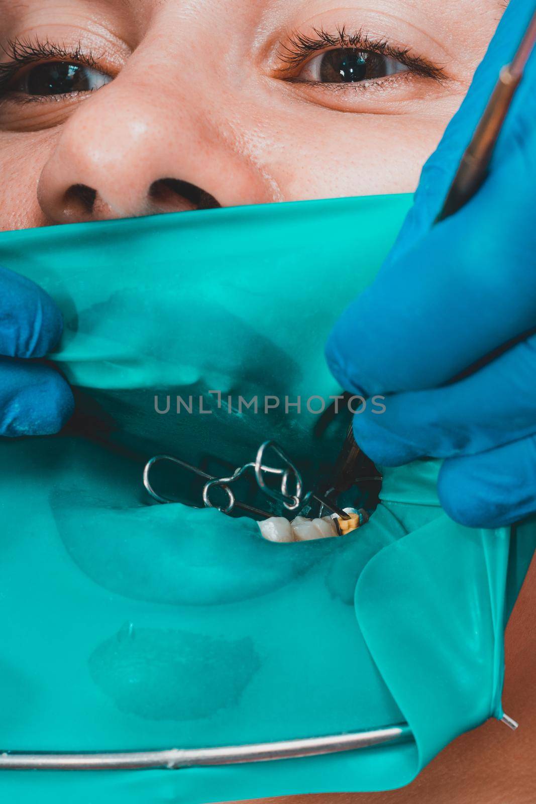 A patient at a dentist's appointment, a doctor uses a rubber dam to treat teeth, disinfects a tooth for filling.2020