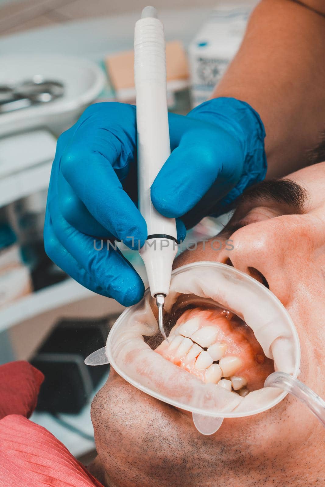 Dental practice, the dentist removes stones and hard plaque from the teeth with the help of ultrasound,patient with retractor and saliva ejector in the mouth.2020