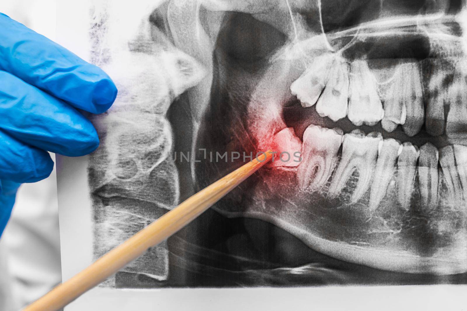 The dentist's hand in a medical rubber glove holds a x-ray image of the mouth and points to a well-made wisdom tooth, close-up.