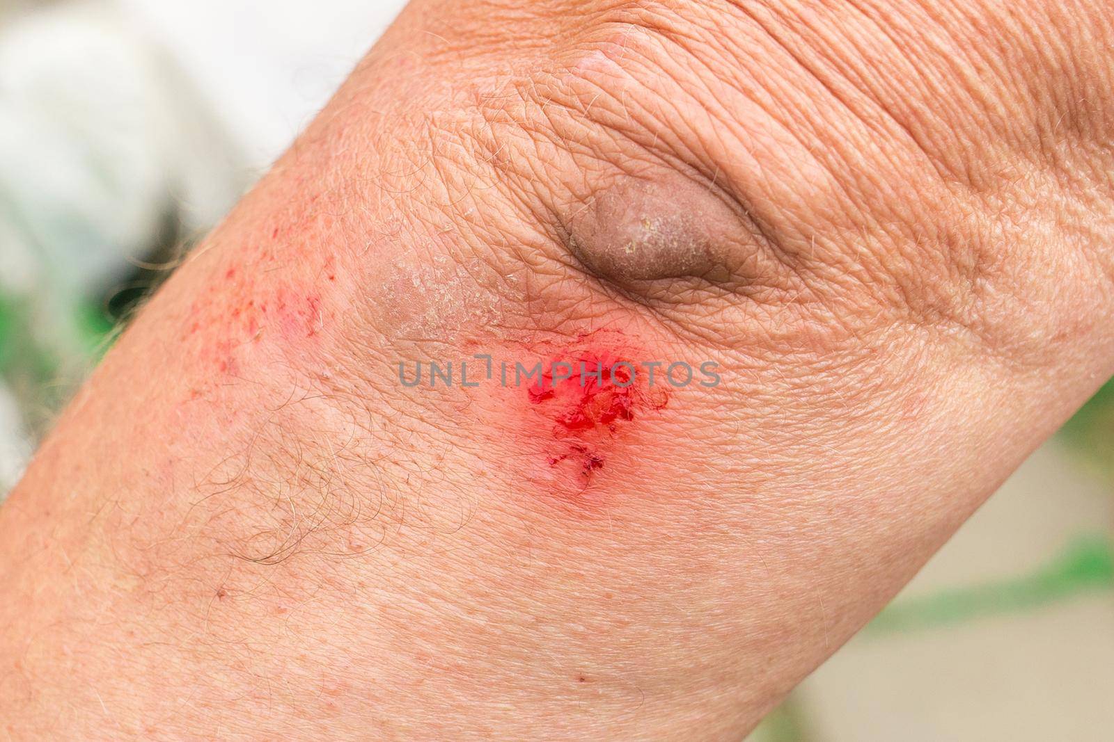 Damaged or torn wound to the elbow with the blood of an elderly person, close-up.