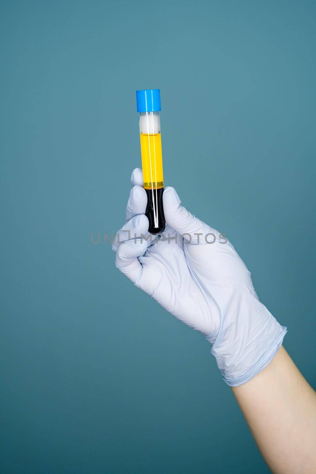 Blood plasma in vitro gloved hand holding by Zorgen