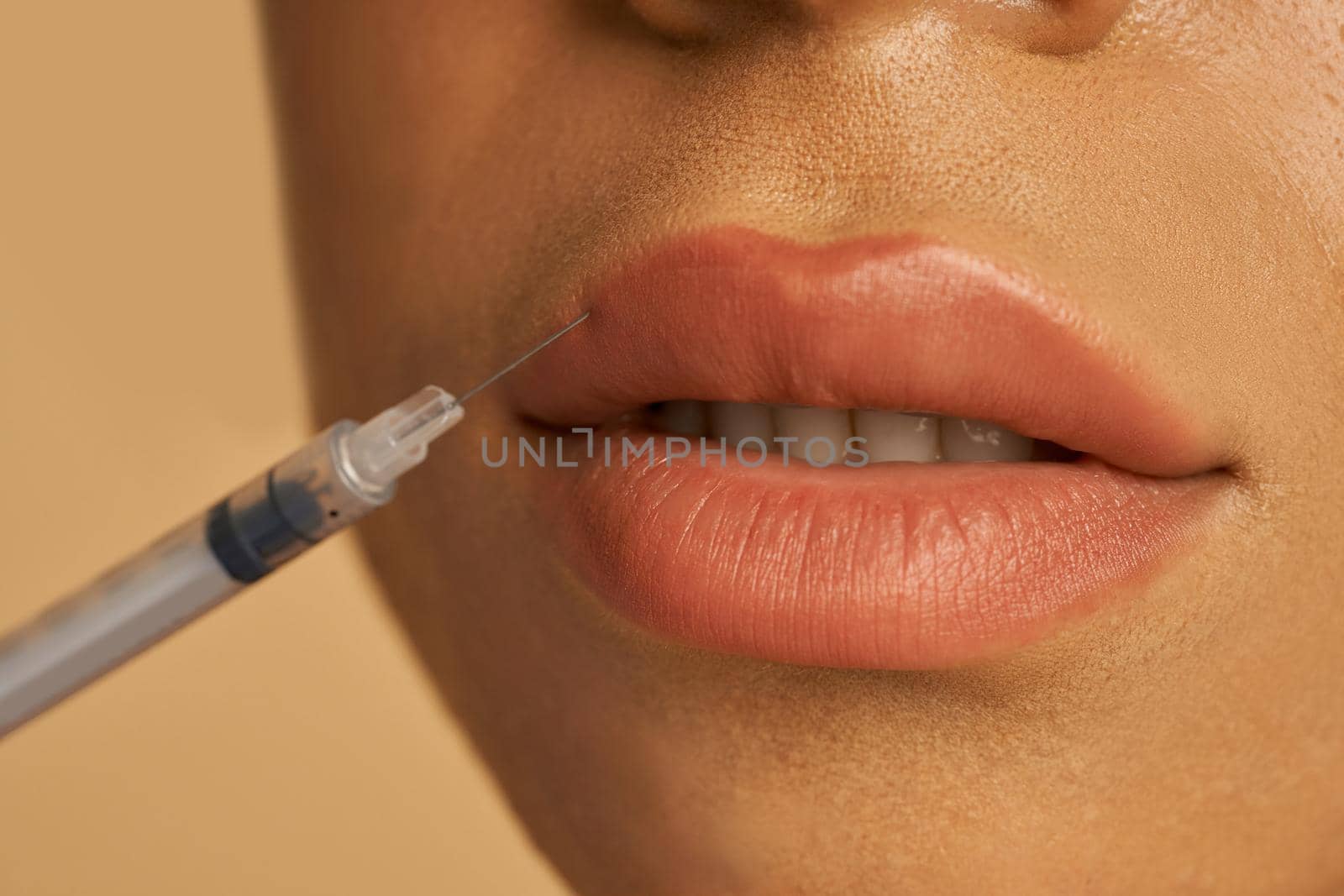 Close up shot of cosmetic injection to the lips of young woman isolated over beige background. Beauty, cosmetology concept. Horizontal shot