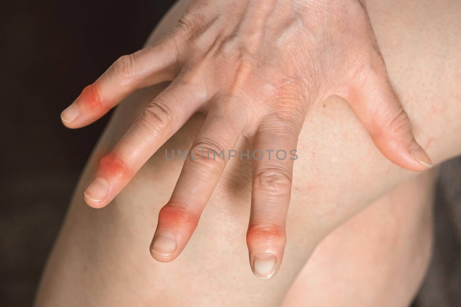 Elderly woman's hands with sore fingers. Finger treatment concept.