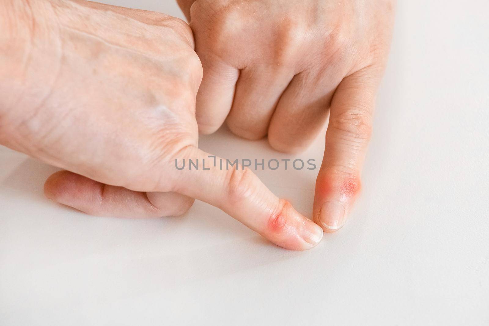 Two hands of an elderly woman indicate a disease of fingers and a change in joints close-up by AYDO8