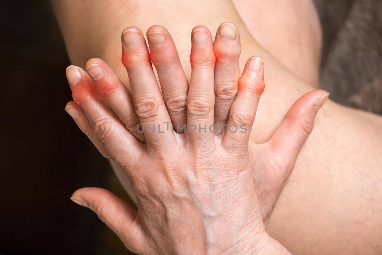 Elderly woman's hands with sore fingers. Finger treatment concept.