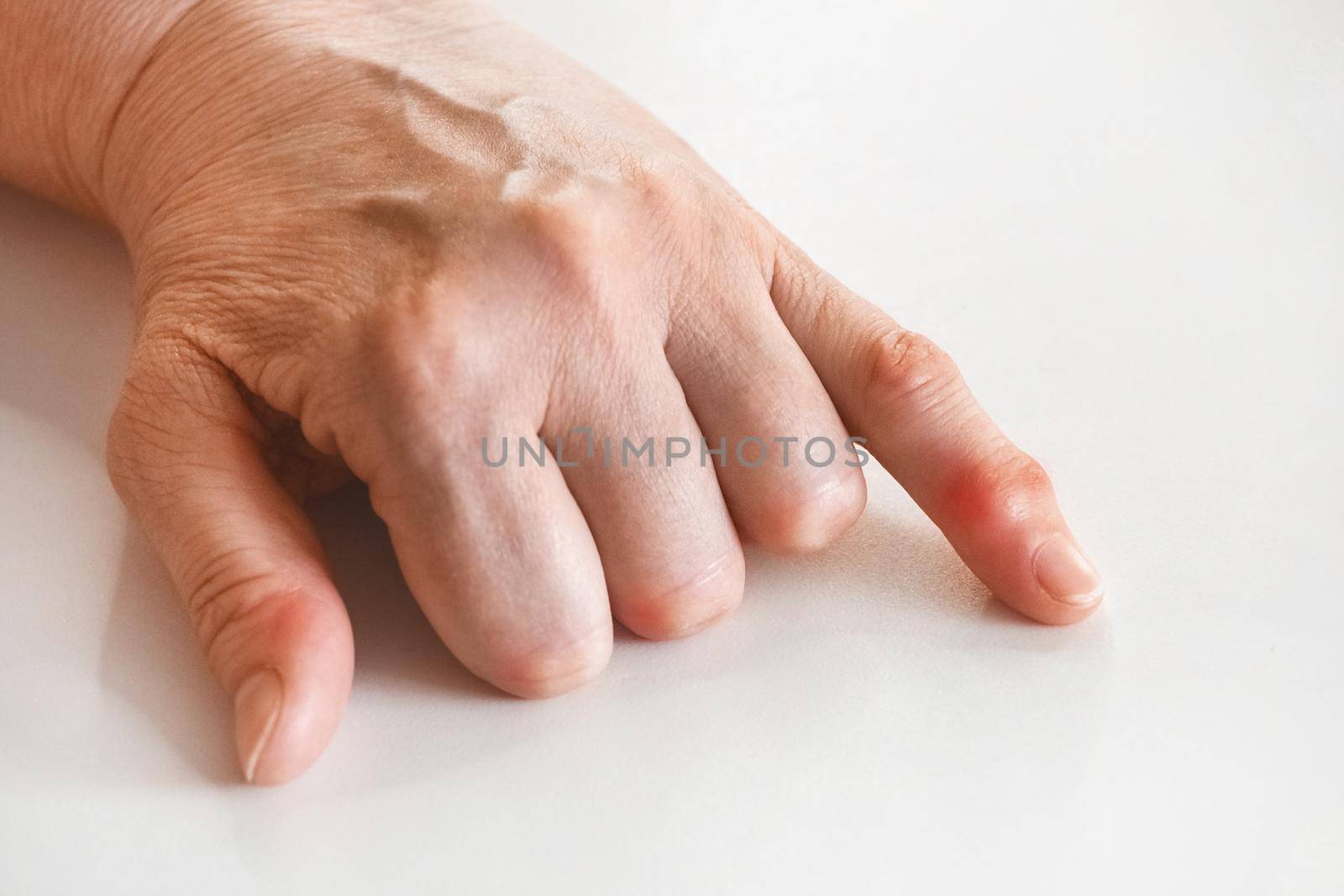 The hand of an elderly woman with hand rheumatism and a change in joints close-up.