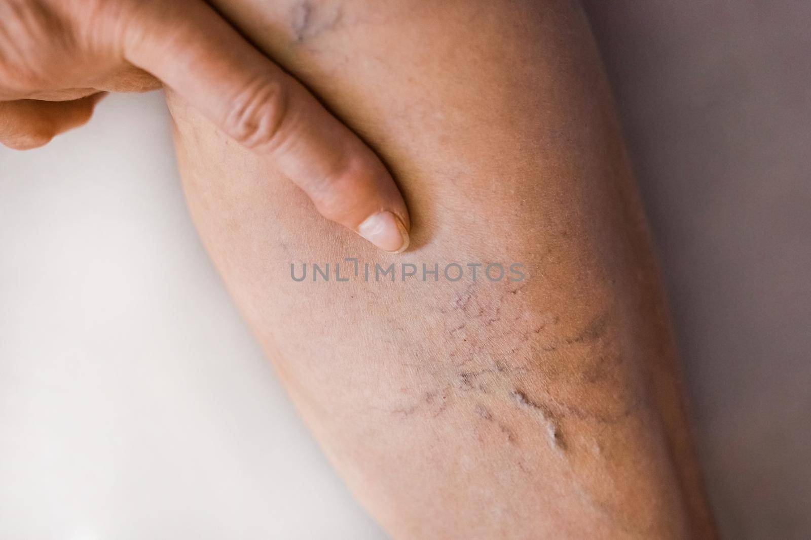 The finger of an elderly woman shows on varicose veins, sick female legs.