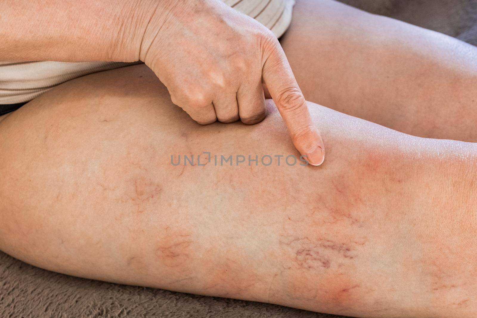 The hand of an elderly woman shows on varicose veins, sick female legs.