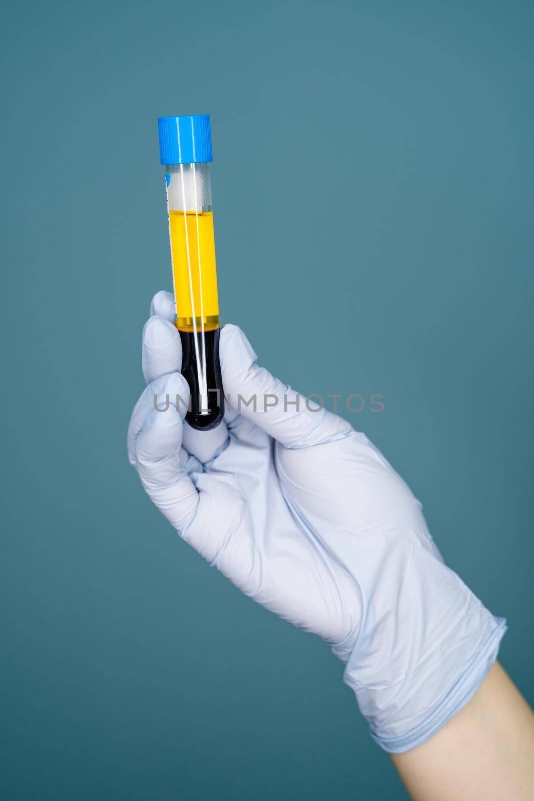 Hand holding extraction of plasma from blood in test tube