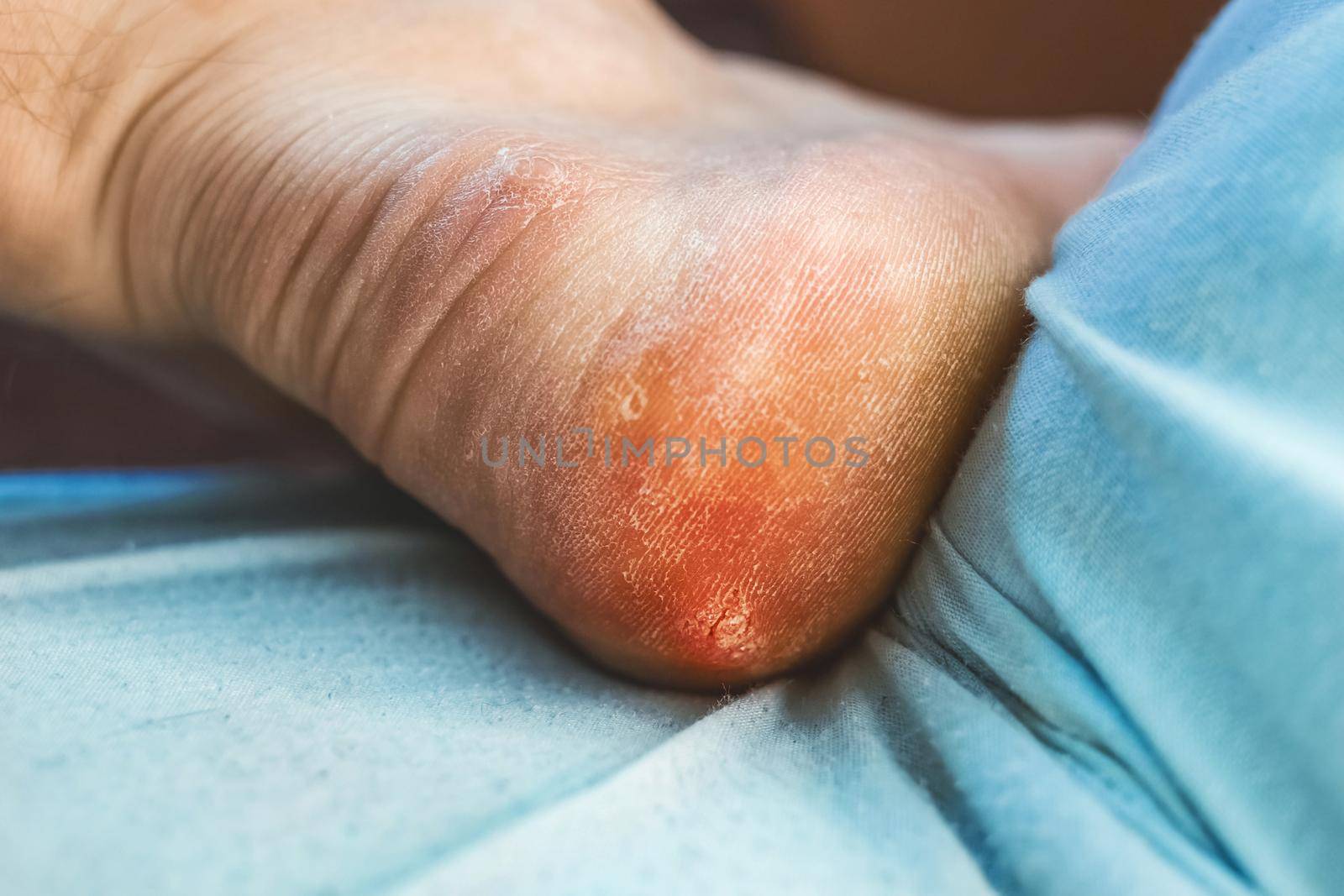 Dry mazole on a cracked heel male. Man's leg with corns, close up.