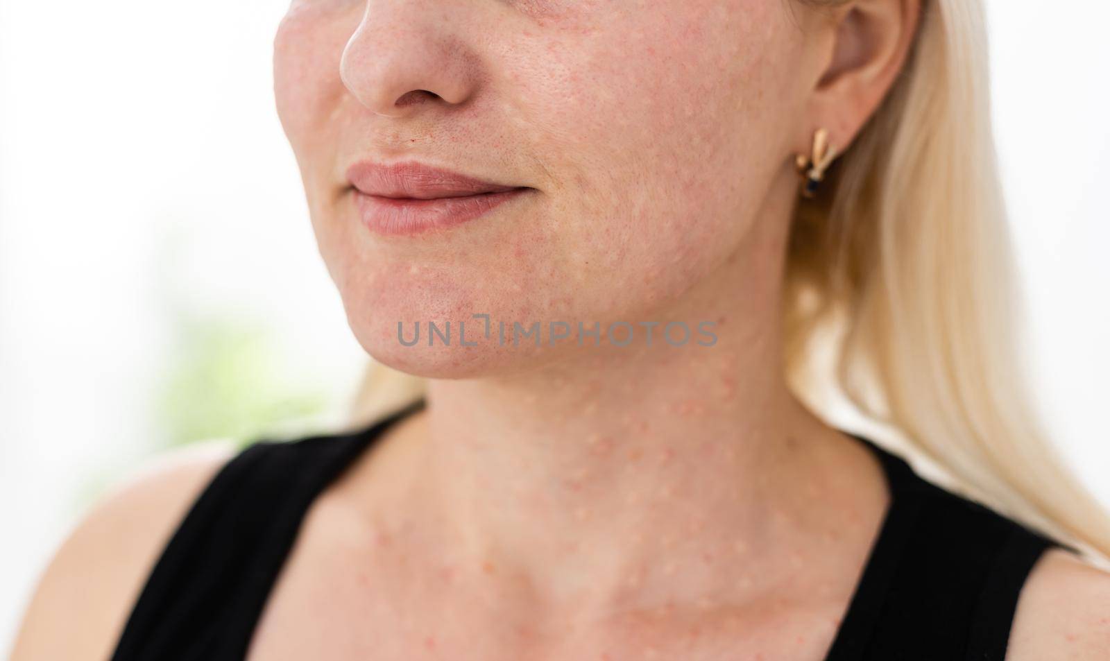 woman papules face, skin texture of woman