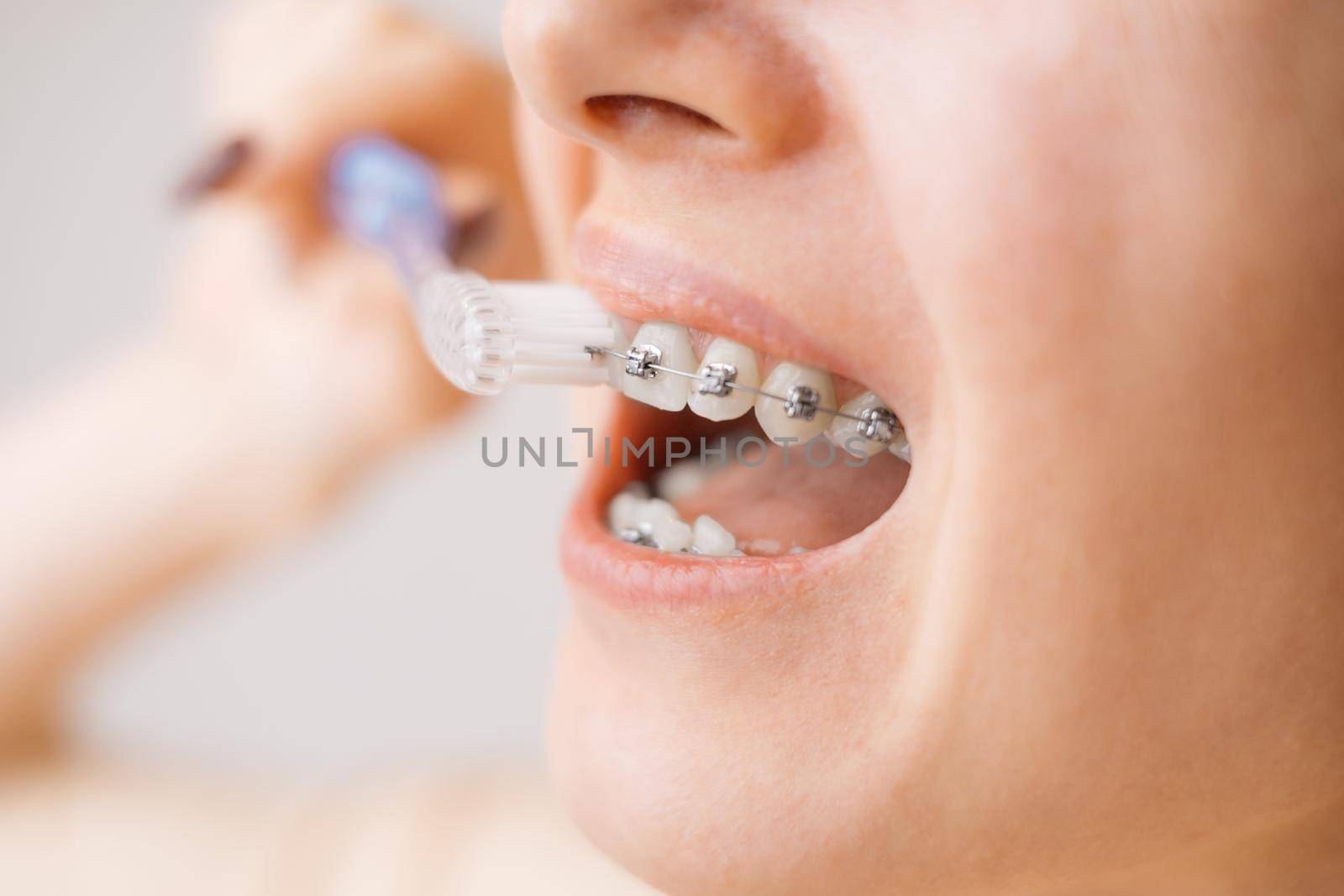 Unrecognizable young woman with braces on her teeth brushing her teeth with a toothbrush, close-up. Dental and oral care. Braces for leveling teeth.