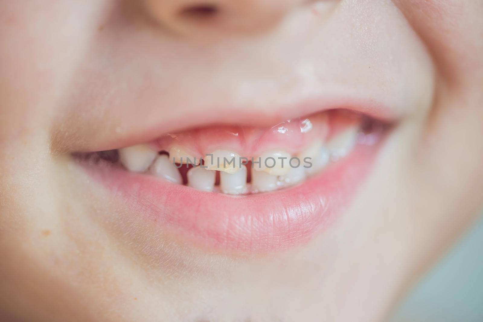 close up shot of baby teeth with caries by galitskaya