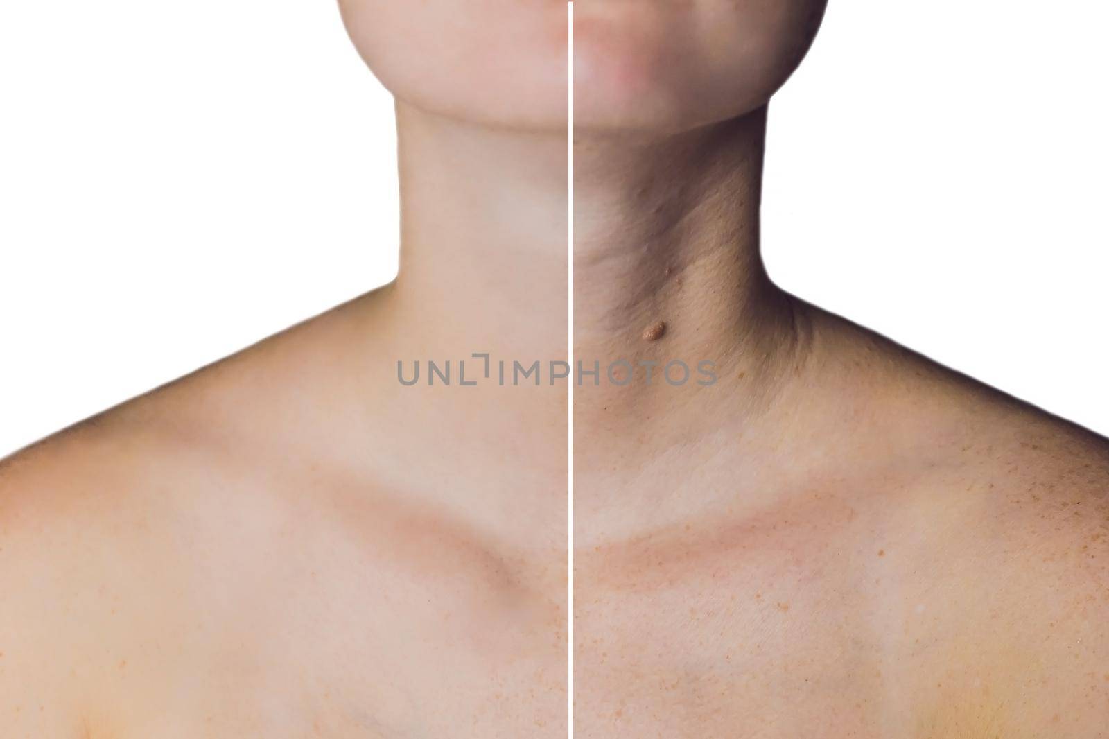 neck of a woman before and after botox. Young and old neck by galitskaya