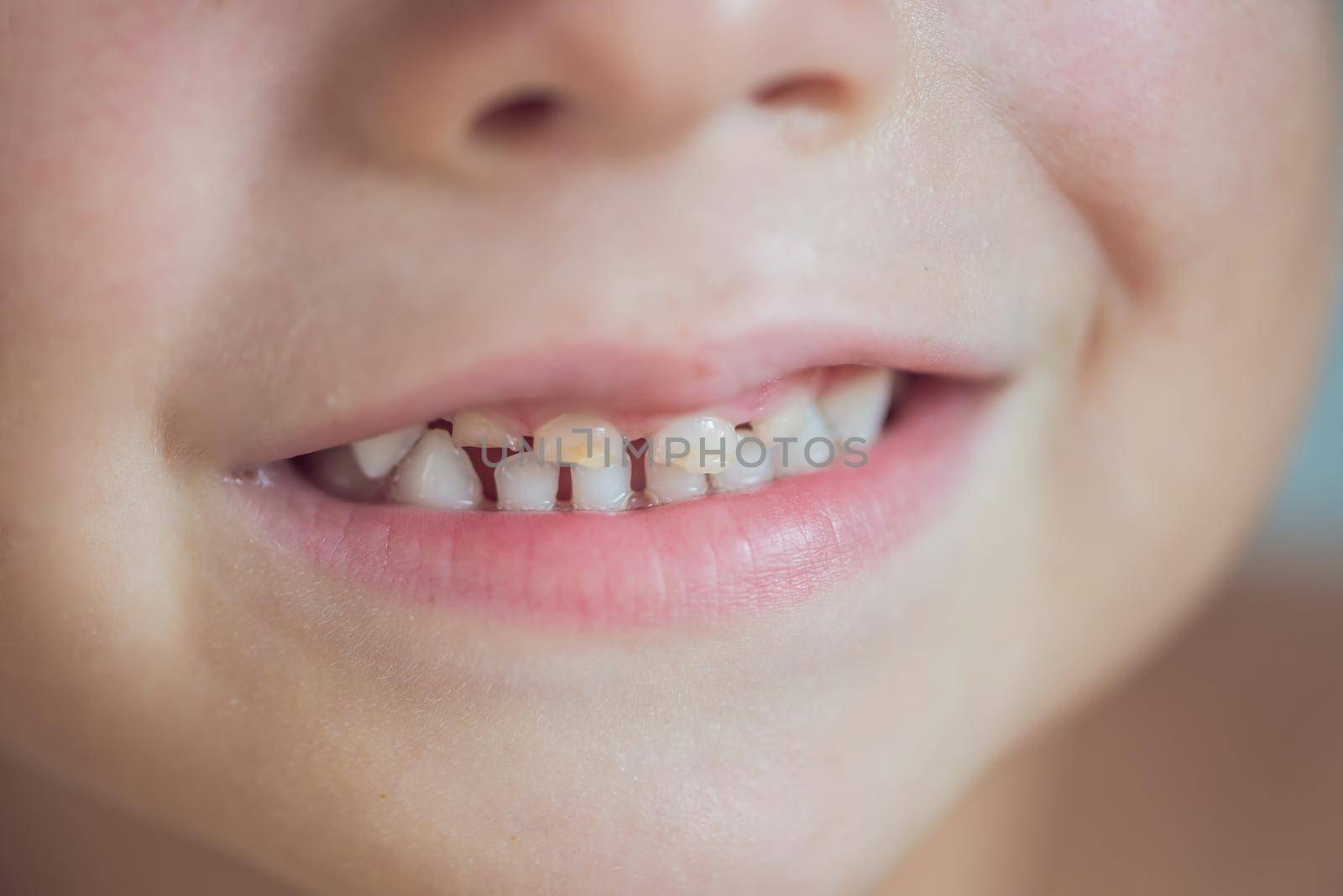 close up shot of baby teeth with caries by galitskaya