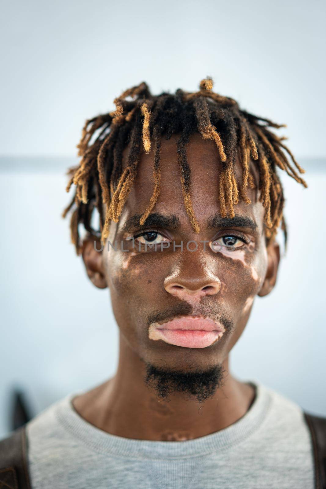 African American black young man with vitiligo skin pigment issue by Zurijeta