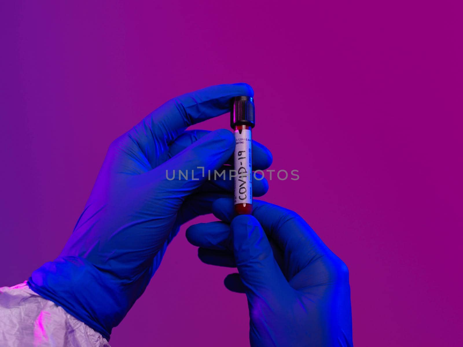 Coronavirus, Doctor holding positive covid-19 virus Blood Sample tube by dotshock