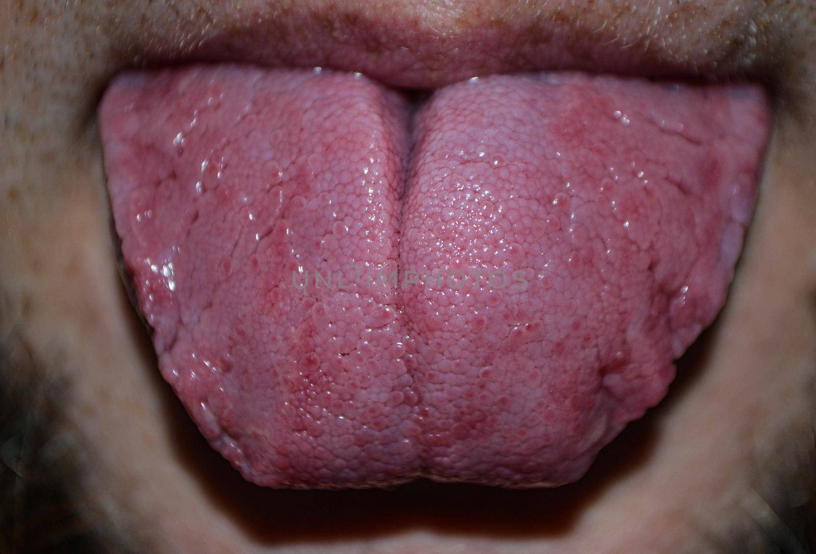 damaged tongue of an adult man. High quality photo