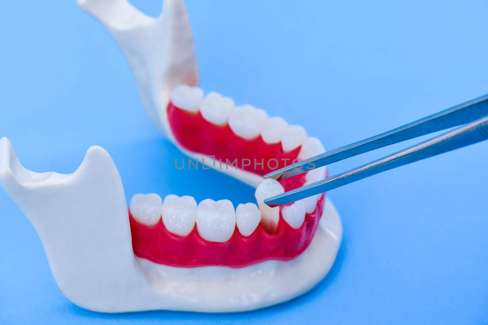 tweezers pulling tooth from the lower jaw anatomy model medical illustration isolated on blue background. Healthy teeth, dental care and orthodontic concept