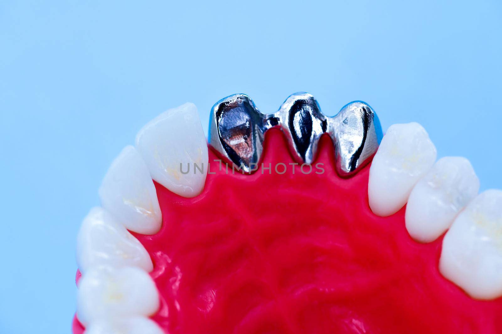 Teeth implant and crown installation process isolated on a blue background. Medically accurate 3D illustration