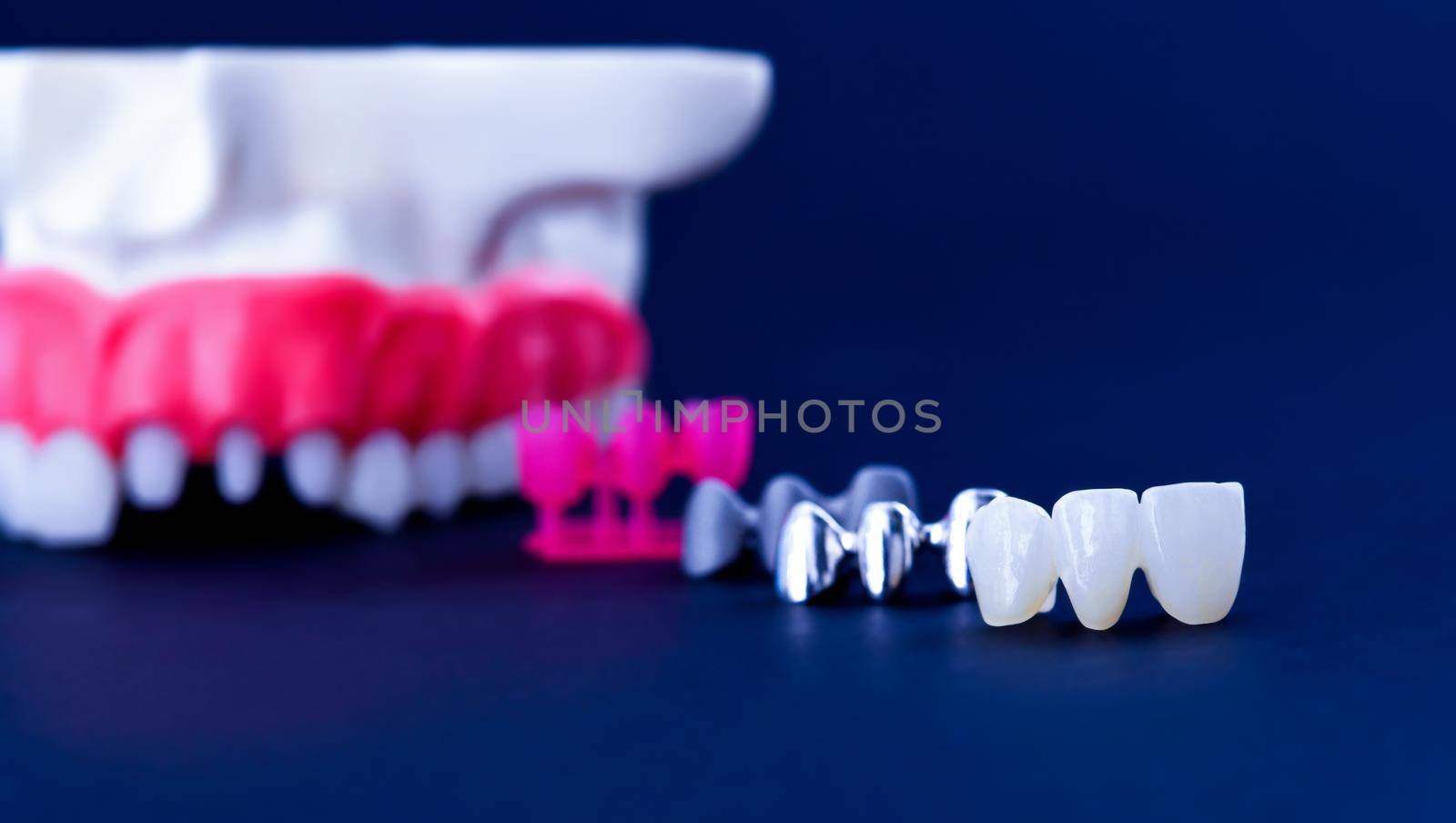 Tooth implant and crown installation process by dotshock