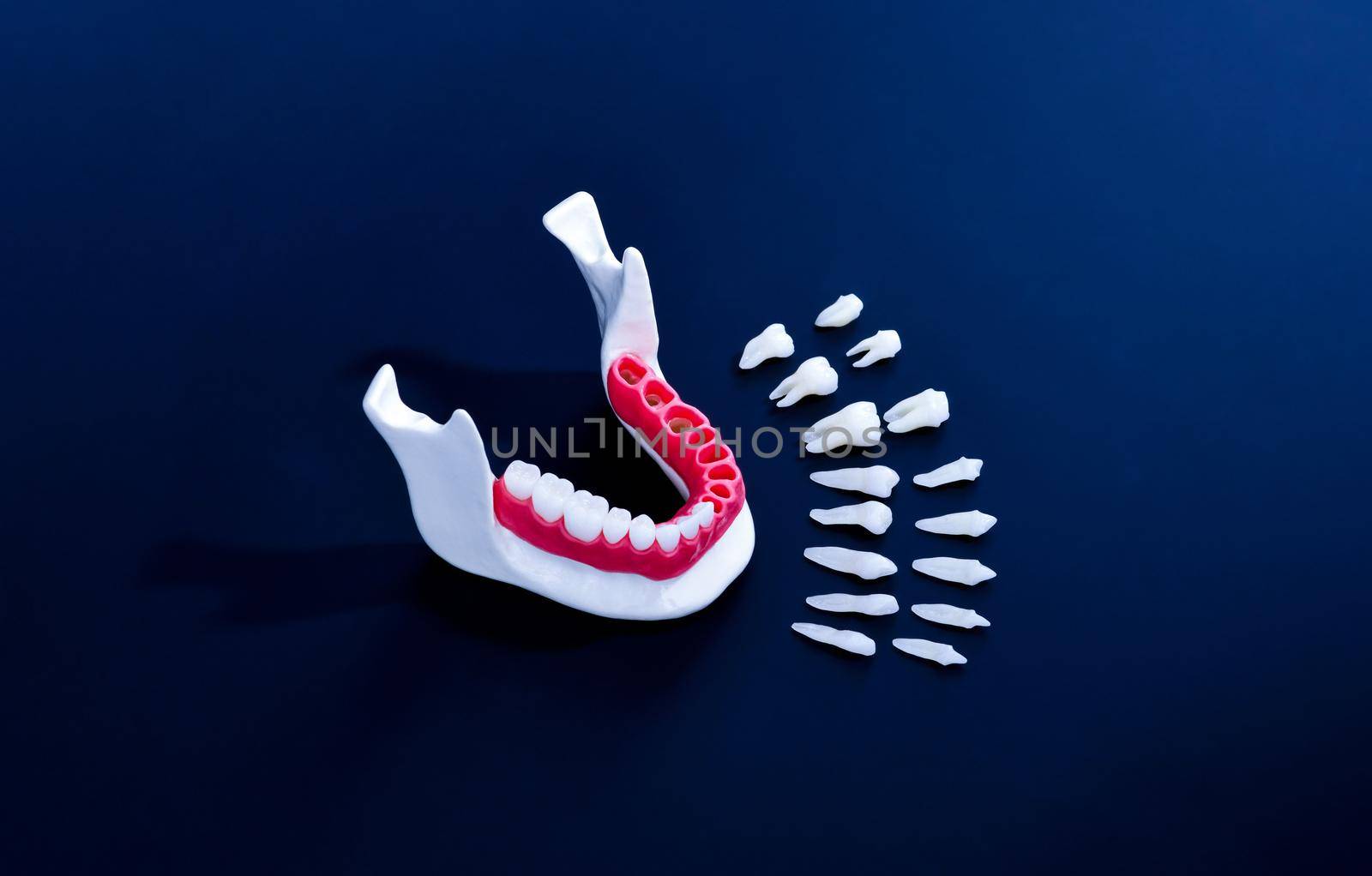 Teeth implant and crown installation process isolated on a blue background. Medically accurate 3D illustration