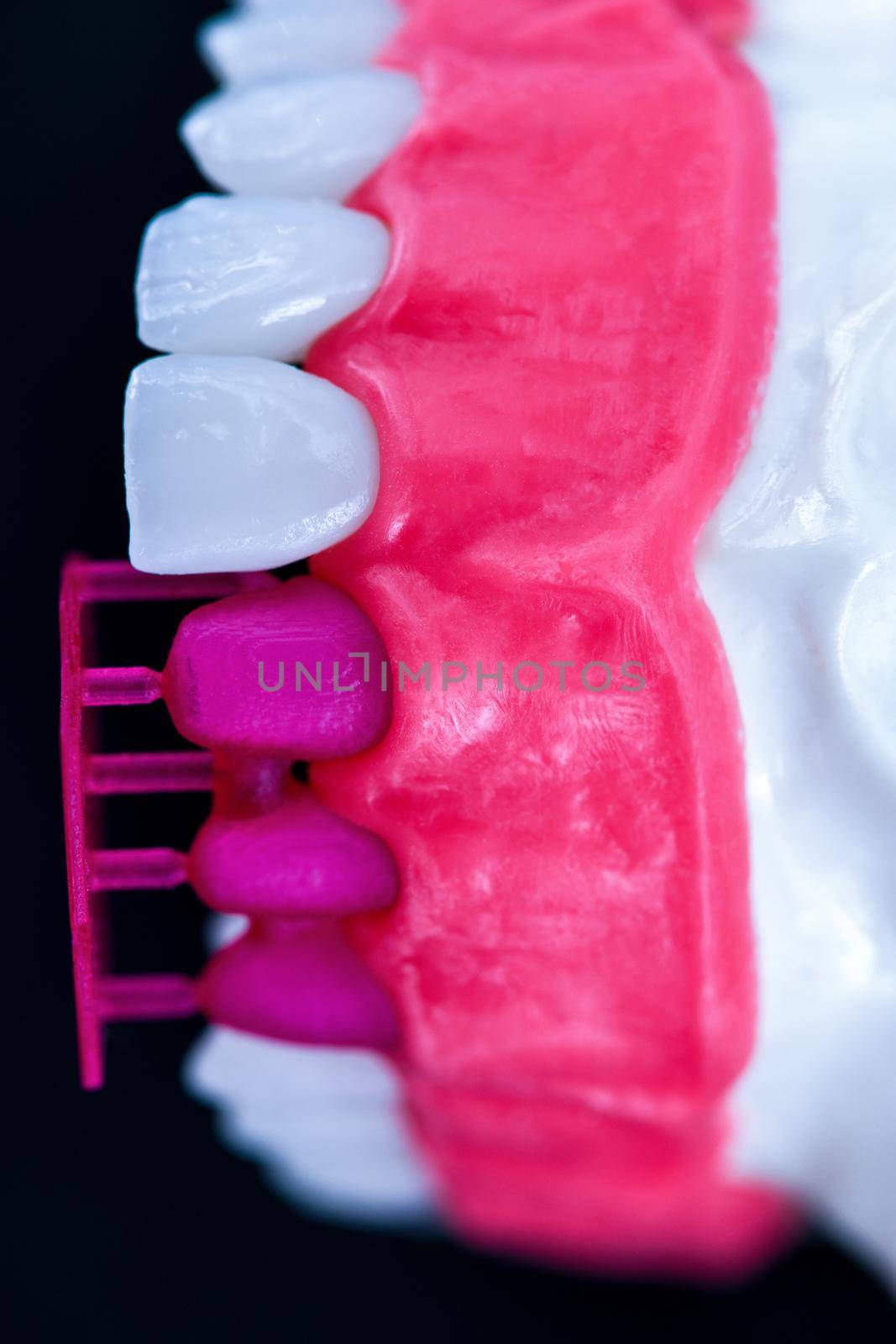 Teeth implant and crown installation process isolated on a black background. Medically accurate 3D illustration